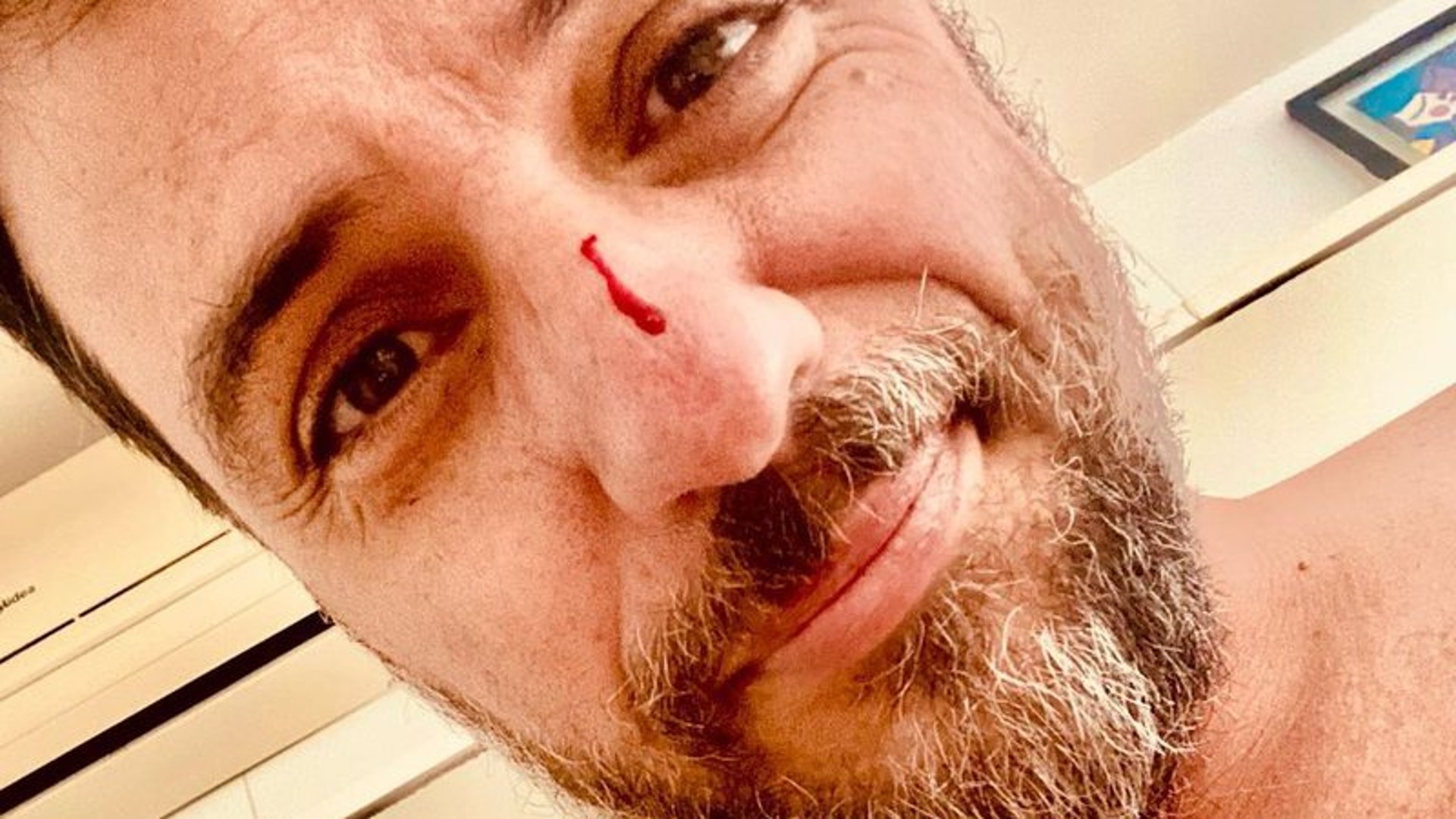 Rodrigo Lombardi surge com nariz e peitoral machucados e assusta fãs: “Faz parte”