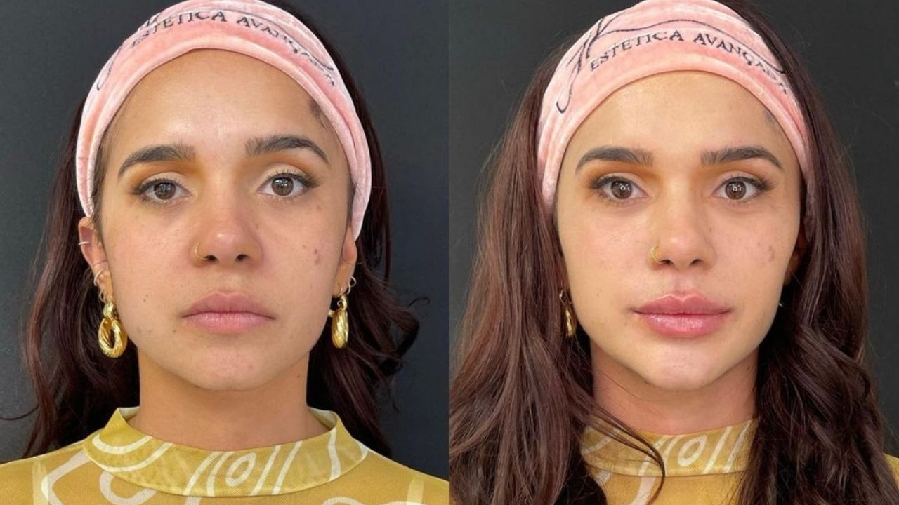 Ex-BBB Gizelly Bicalho faz harmonização facial e surpreende a web: “Uma nova mulher”