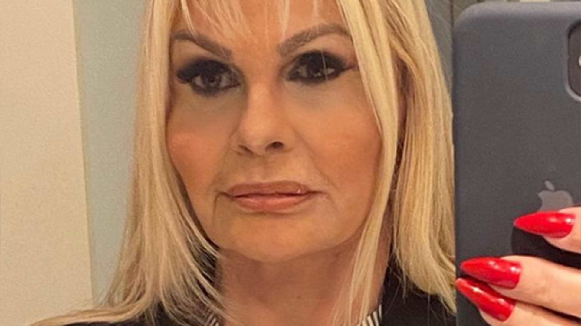 Monique Evans mostra antes e depois de procedimento no rosto