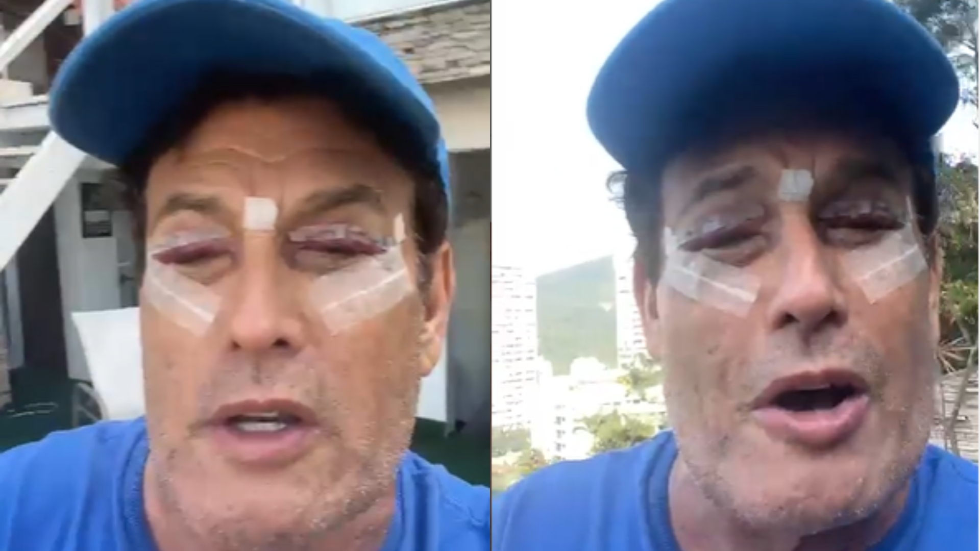 Após cirurgia nas pálpebras, Sérgio Mallandro mostra recuperação