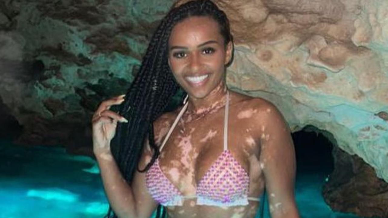No Mês da Conscientização do Vitiligo, Natália Deodato conta sua história com a doença: ”Me odiei”