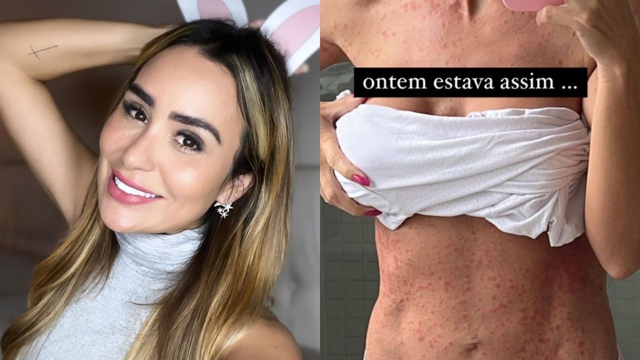 Ex-BBB Letícia Santiago preocupa internautas ao mostrar corpo com inflamação: “Aguardando”