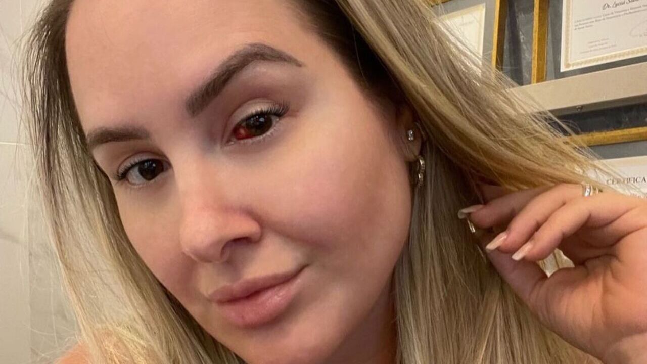 Ex-BBB Patrícia Leitte sofre derrame ocular e desabafa: ”Senti na pele a rejeição”