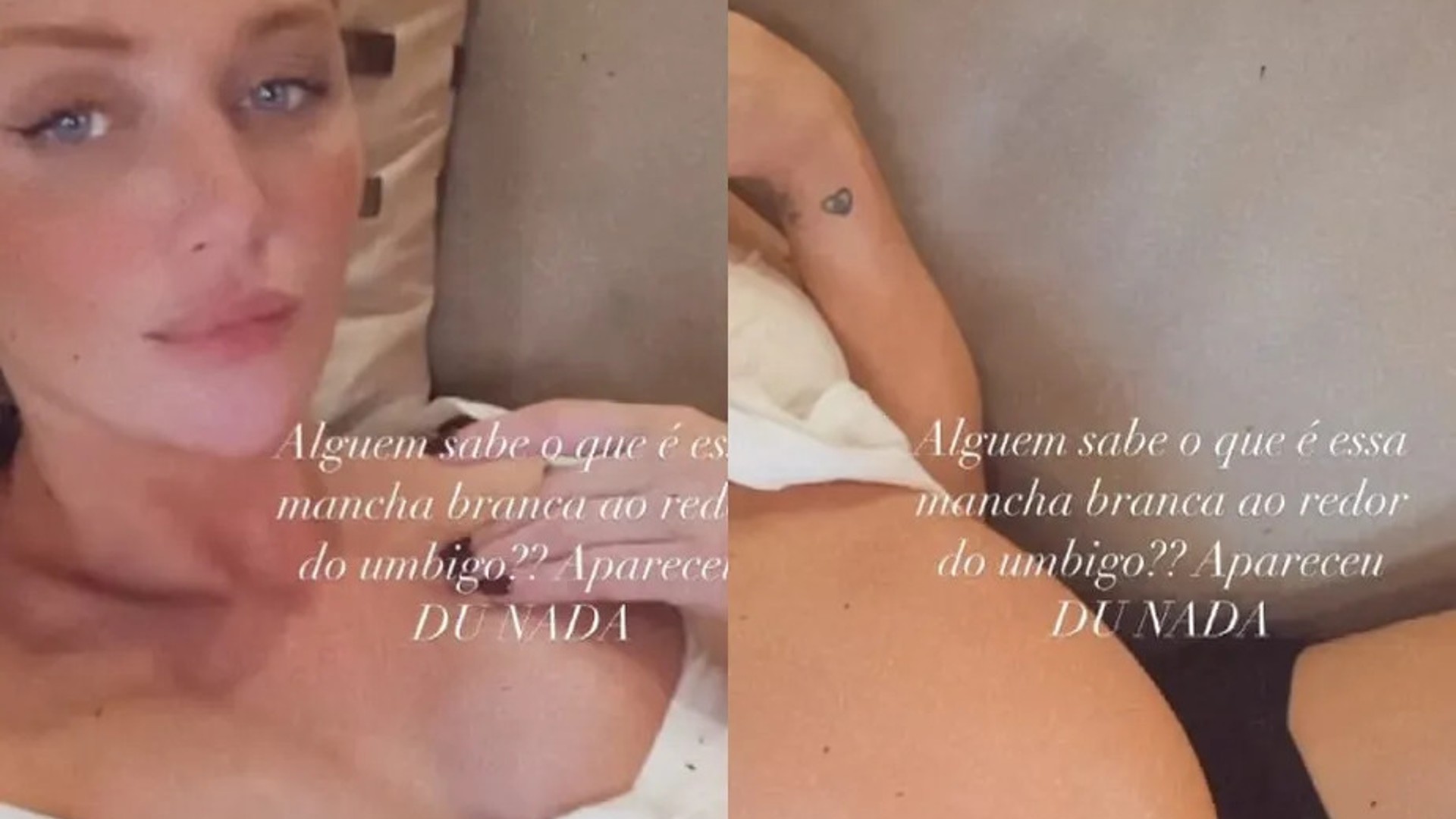 Cintia Dicker exibe mancha branca na barriga e pede ajuda dos internautas