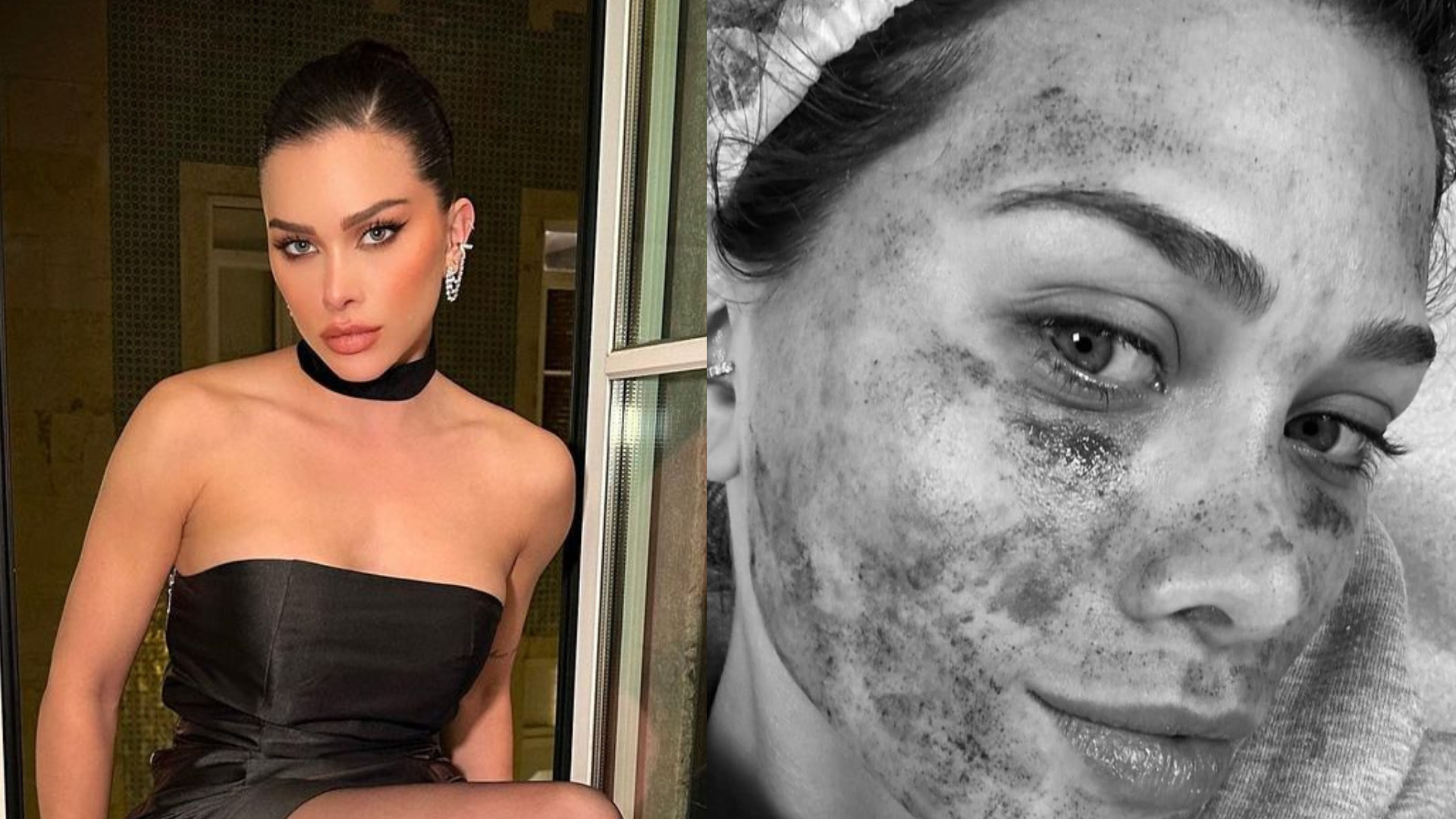 Flávia Pavanelli mostra realidade e aparece com rosto sangrando após procedimento