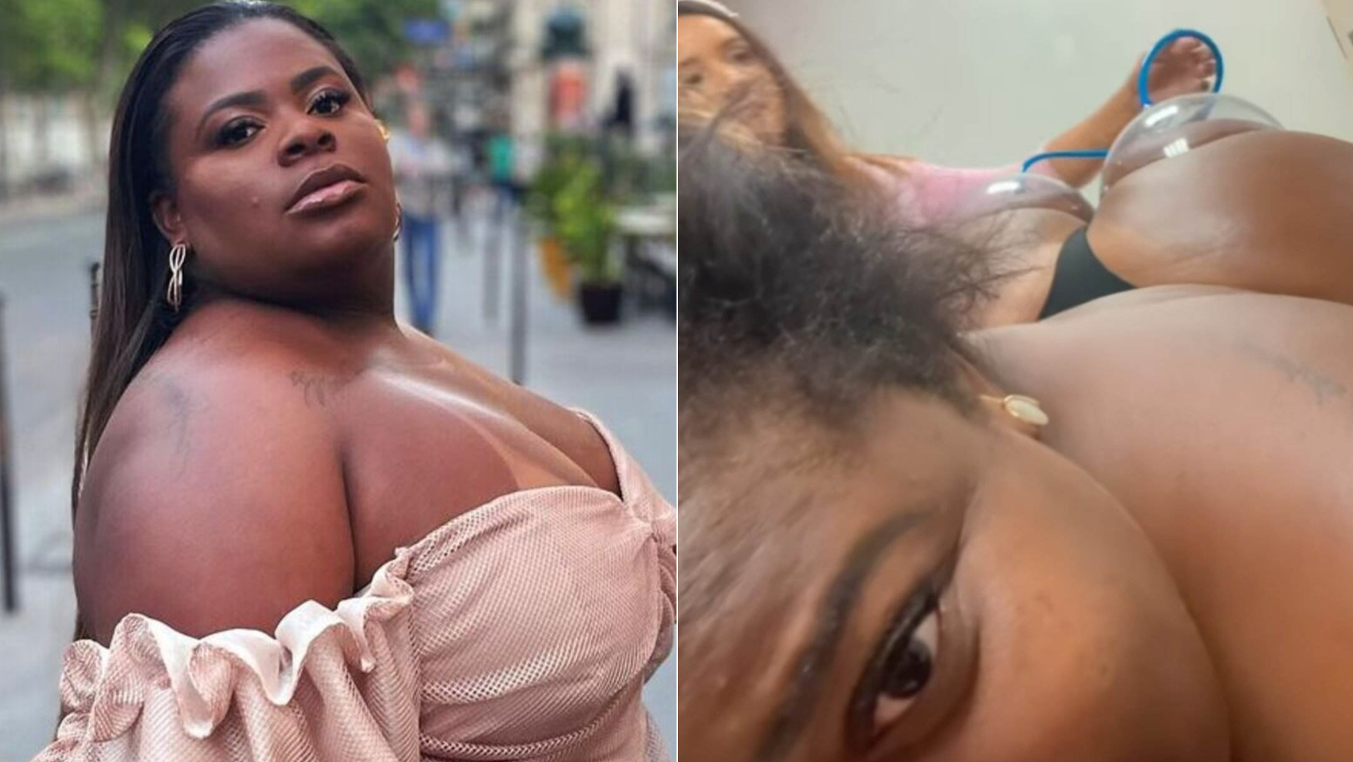 Após ‘lipo’, Jojo Todynho faz tratamento no bumbum: ”To com uma fibrose”