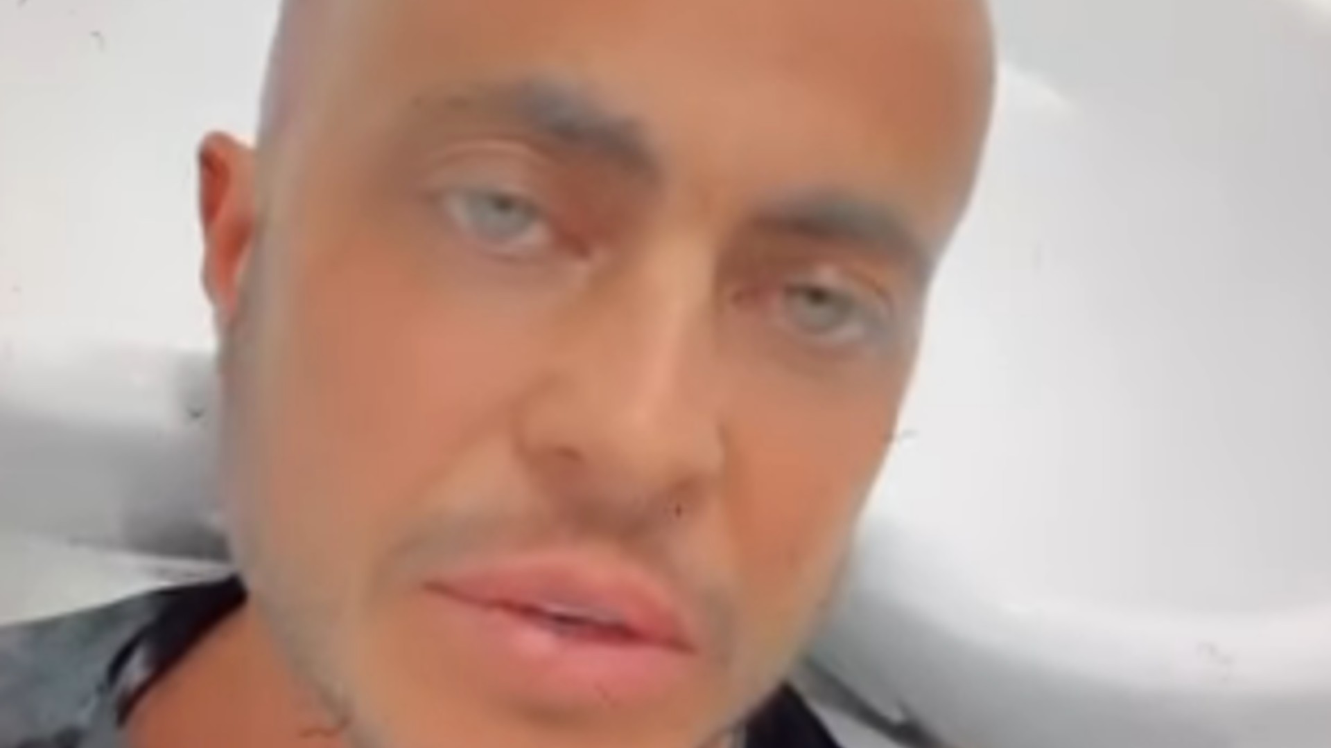 Thammy Miranda raspa cabeça para realizar transplante de cabelo e fãs aprovam visual