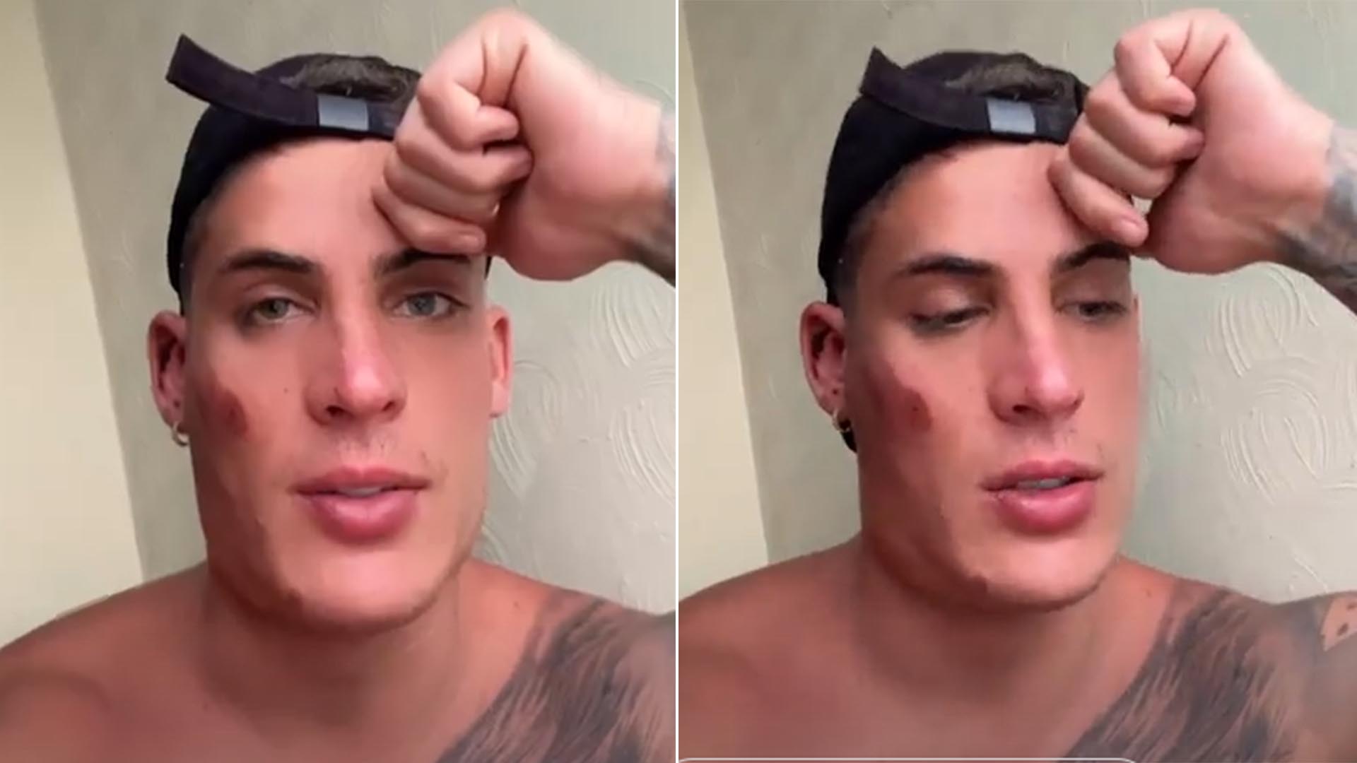 Ex-A Fazenda Tiago Ramos aparece com o rosto machucado após briga