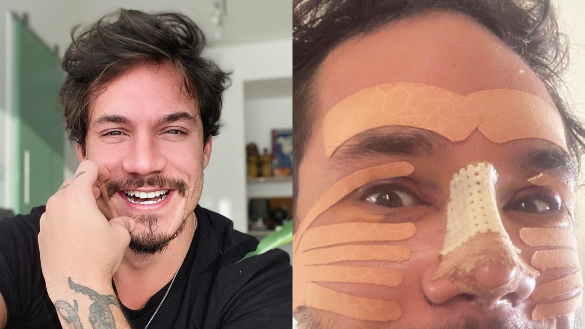 Sem dente, Eliezer surge irreconhecível com curativos após rinoplastia: ”Estou lindo”