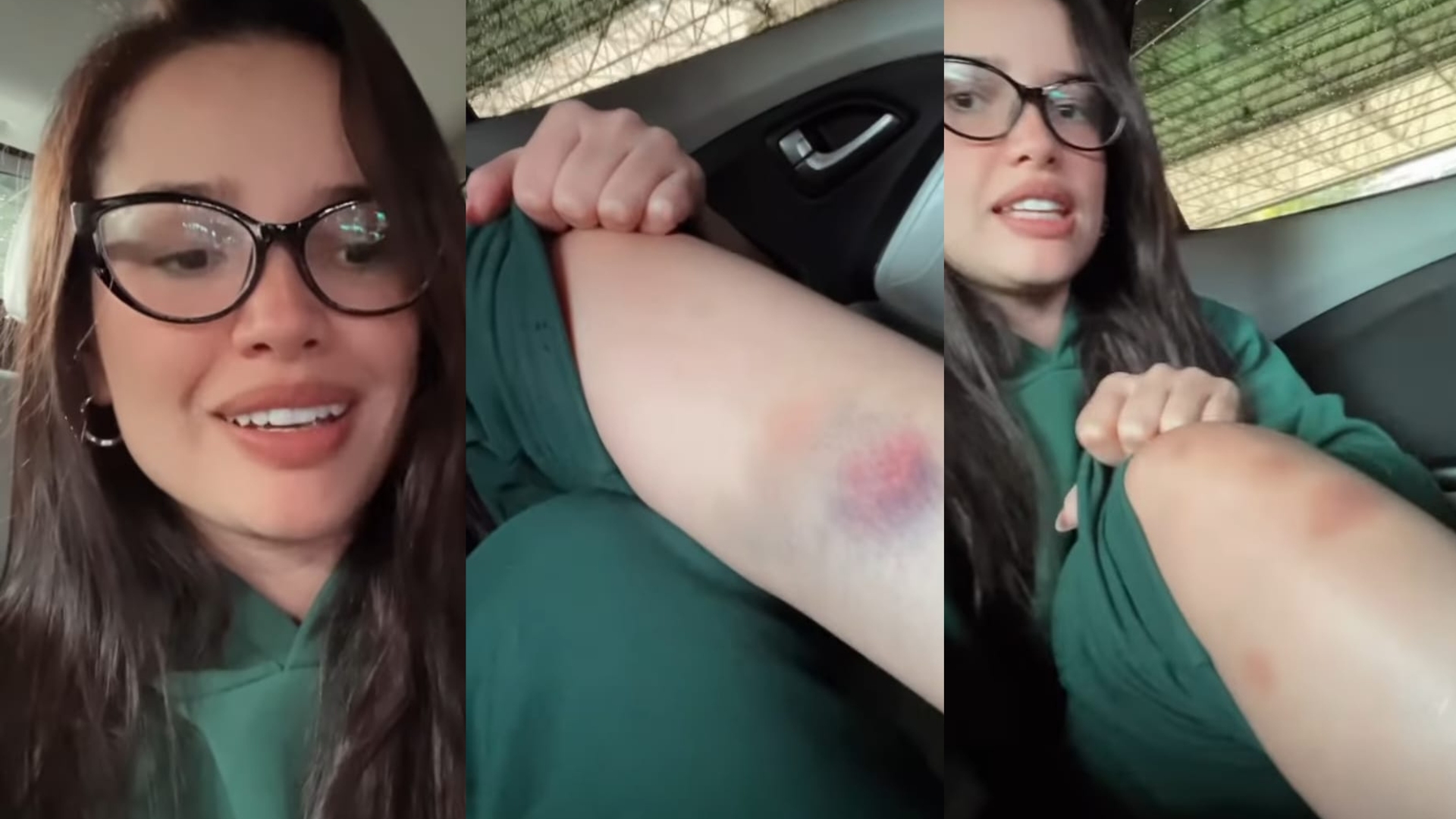 Juliette Freire mostra hematomas no corpo após fim de semana de farra