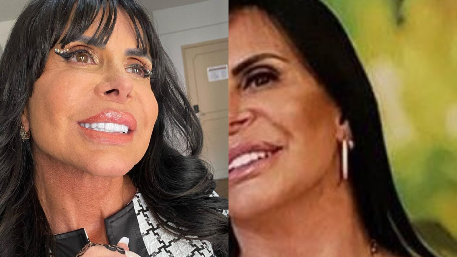 Gretchen mostra como era sua aparência no início da harmonização: ”Recuperei meu rosto”