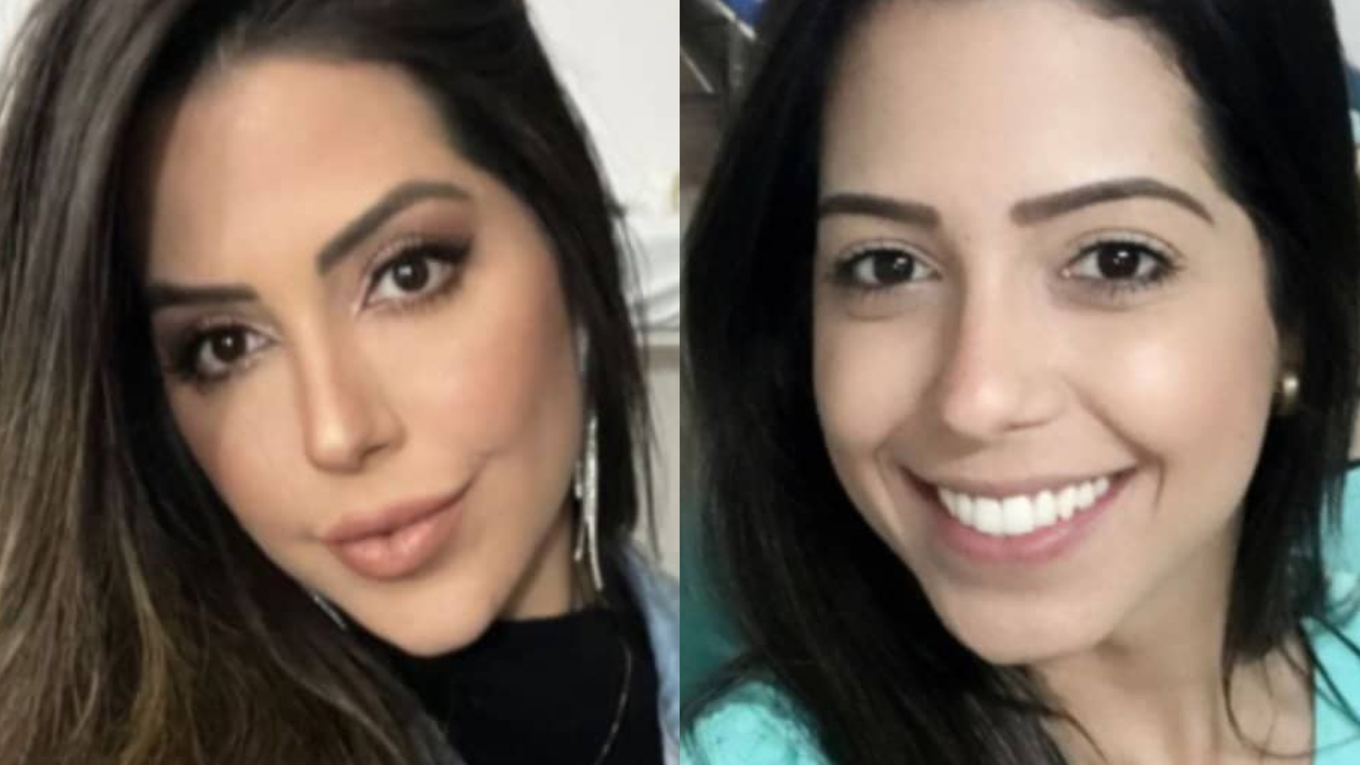 Ex-BBB Laís Caldas choca ao mostrar antes e depois do rosto: ”Diferença grande”