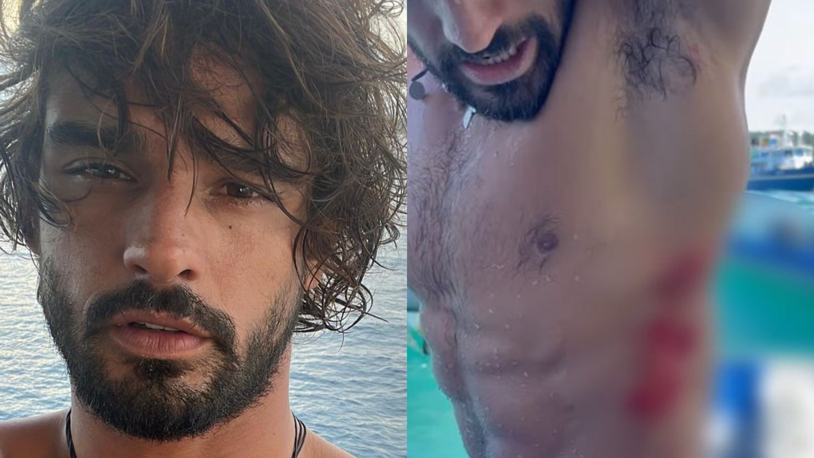 Marlon Teixeira surge sangrando após sofrer acidente de surf