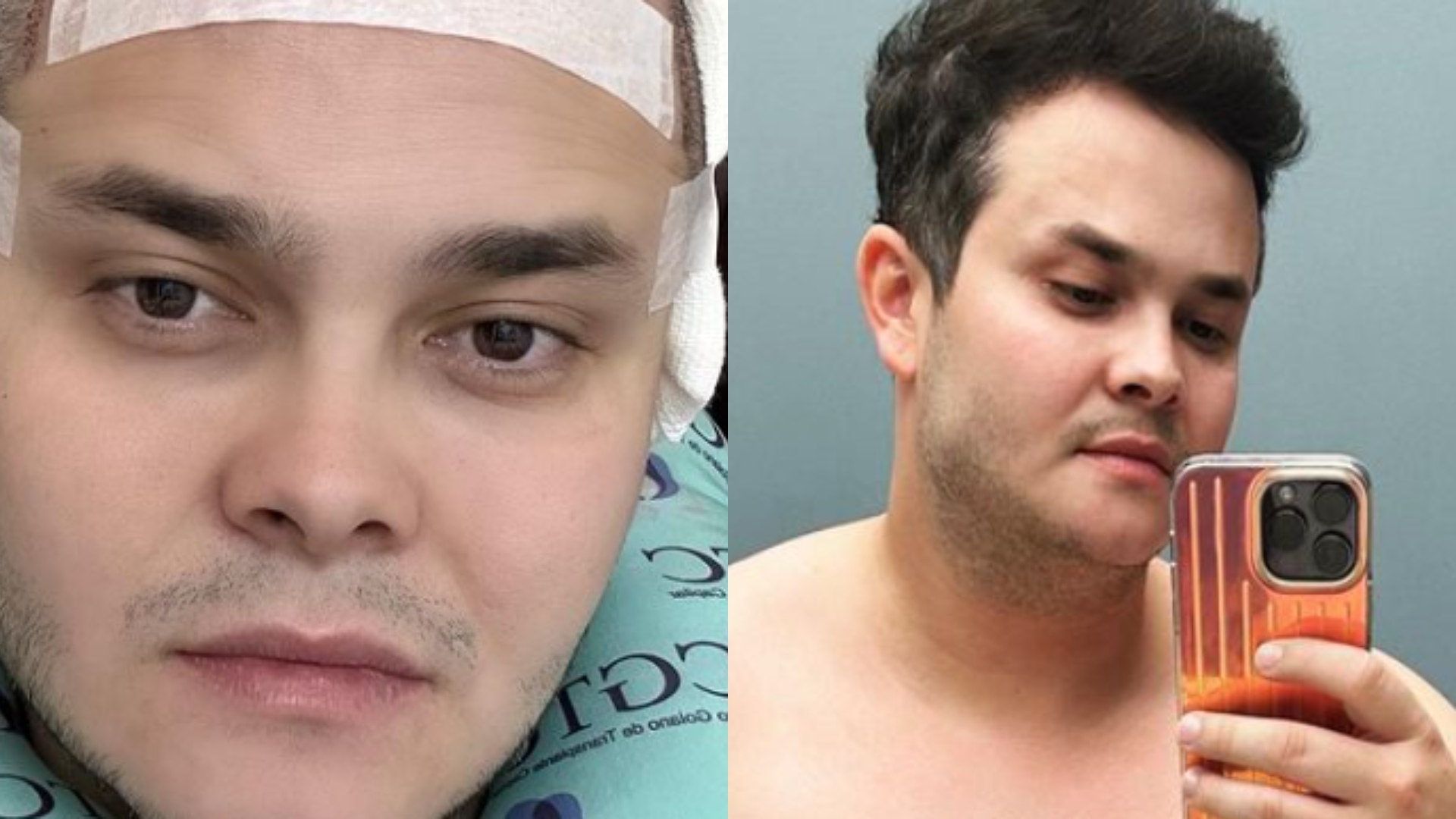 Matheus, da dupla com Kauan, realiza transplante capilar: ‘Estética’