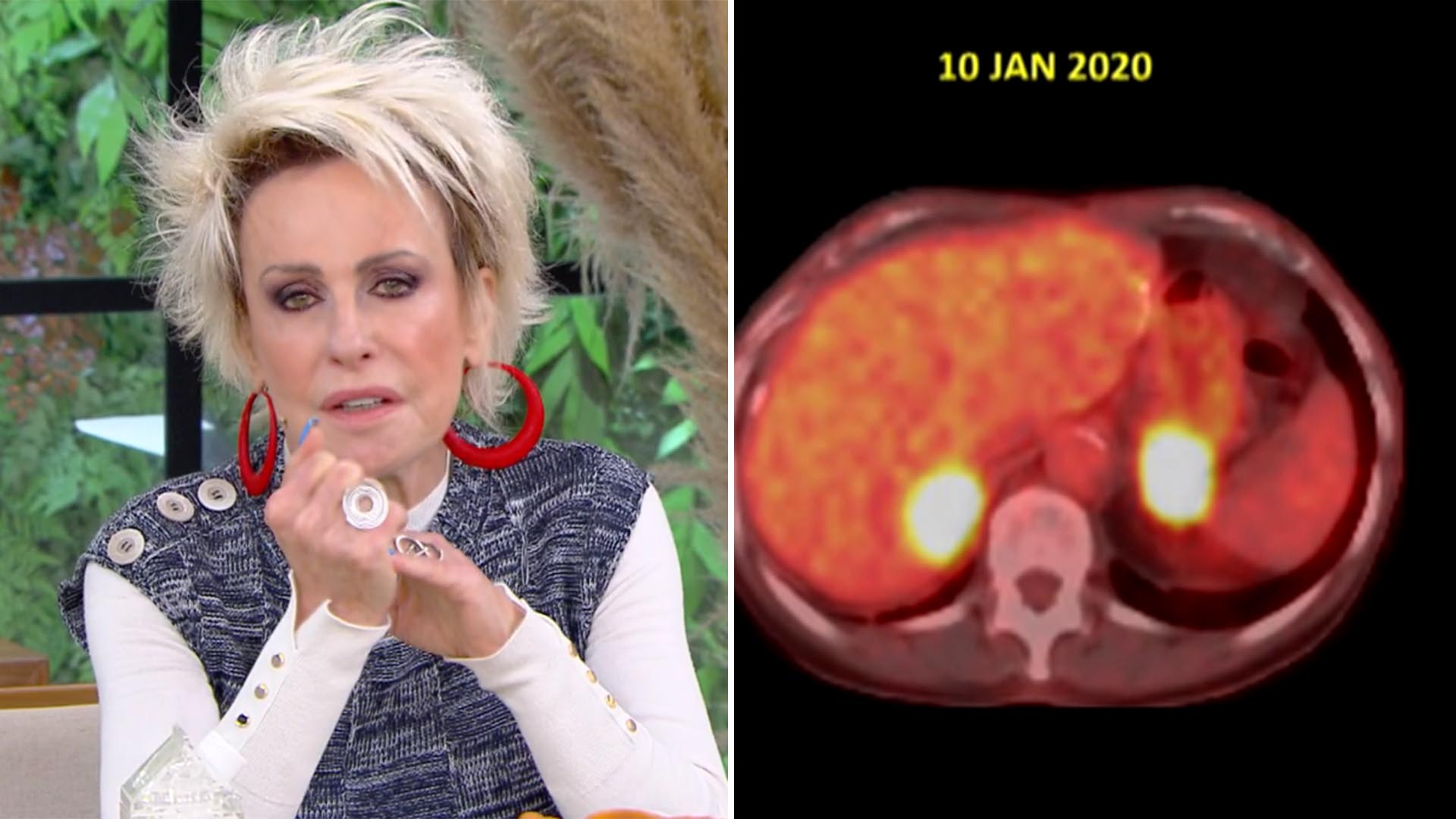 Ana Maria Braga revela detalhes da luta contra o câncer e médico diz: ‘Era grave’