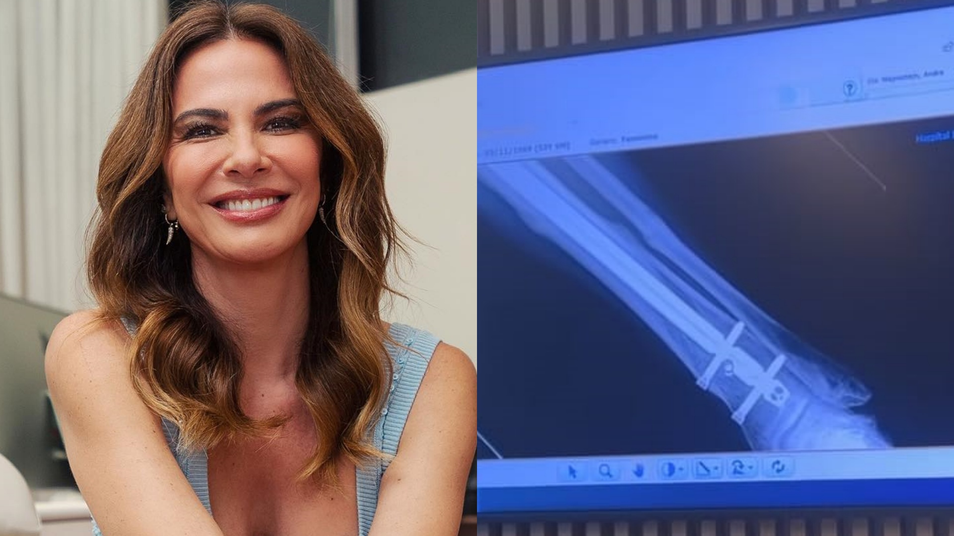 Luciana Gimenez fará nova cirurgia após acidente de esqui: “Tirar o parafuso”
