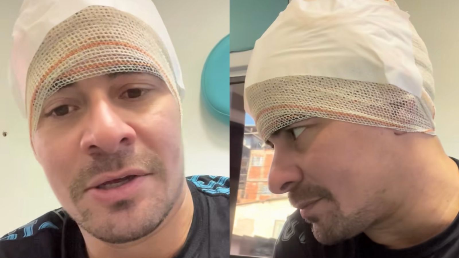 Thiago Martins leva pontos na cabeça após sofrer acidente de trabalho: “Dei o sangue”