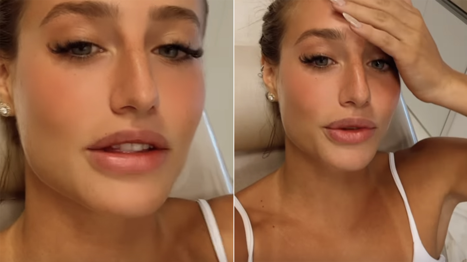 Bruna Griphao decide tirar o preenchimento labial e mostra o resultado