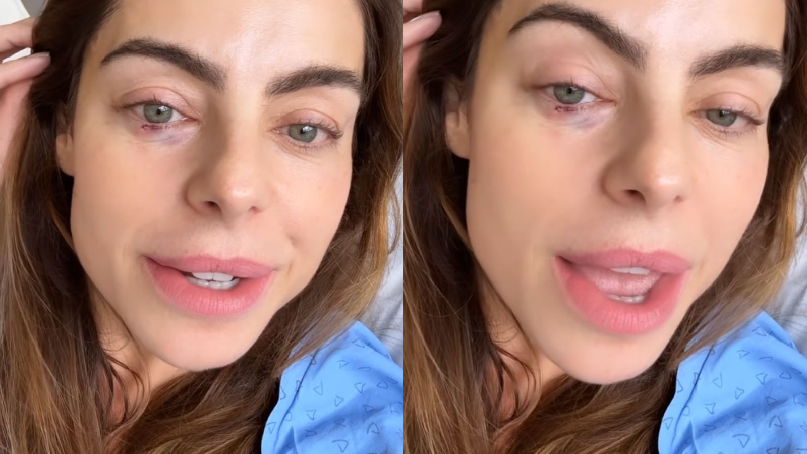 O que aconteceu? Daniella Cicarelli surge no hospital com o olho roxo