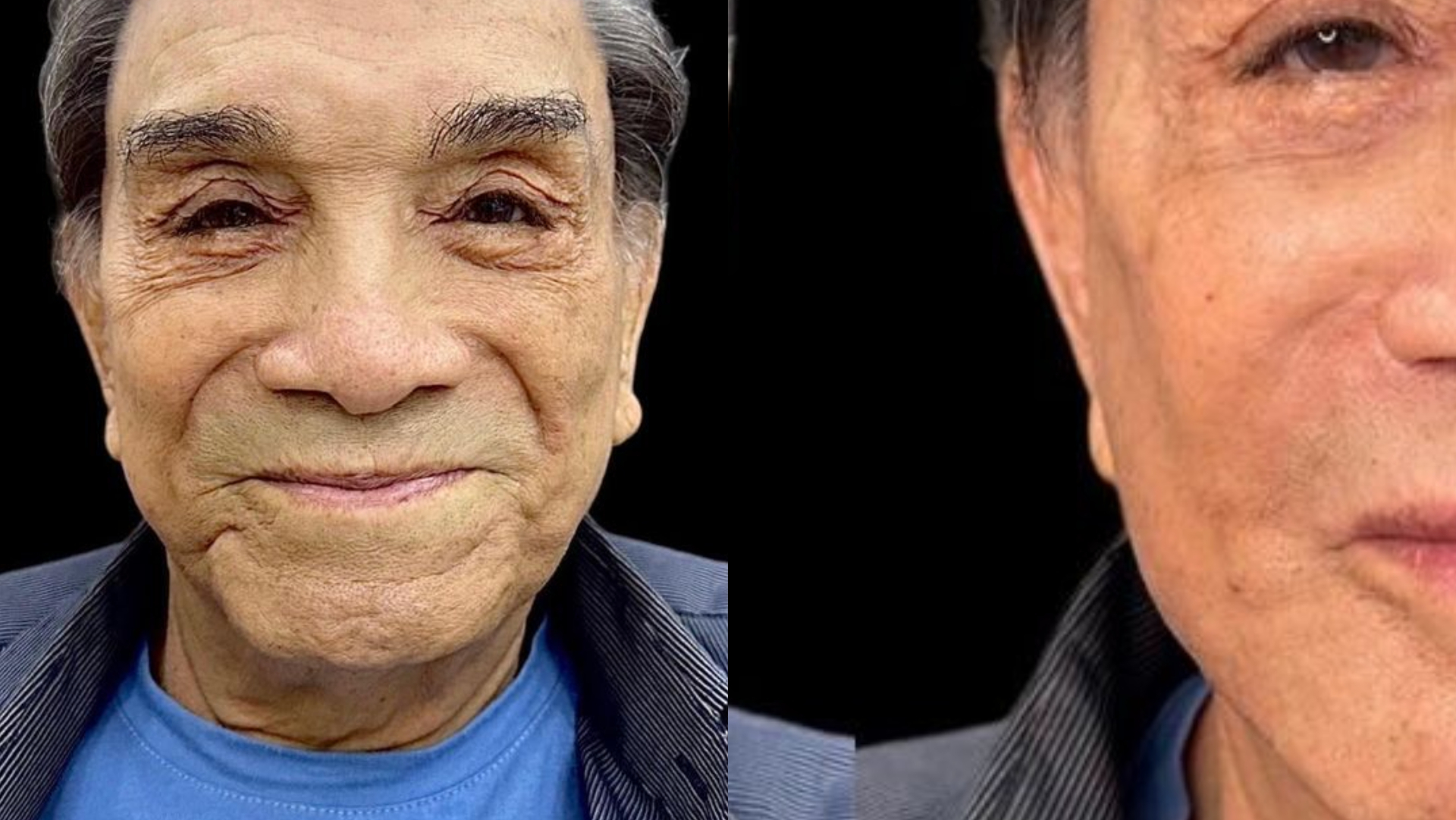 Aos 86 anos, Dedé Santana faz procedimento estético e surpreende: ”Quanta diferença”