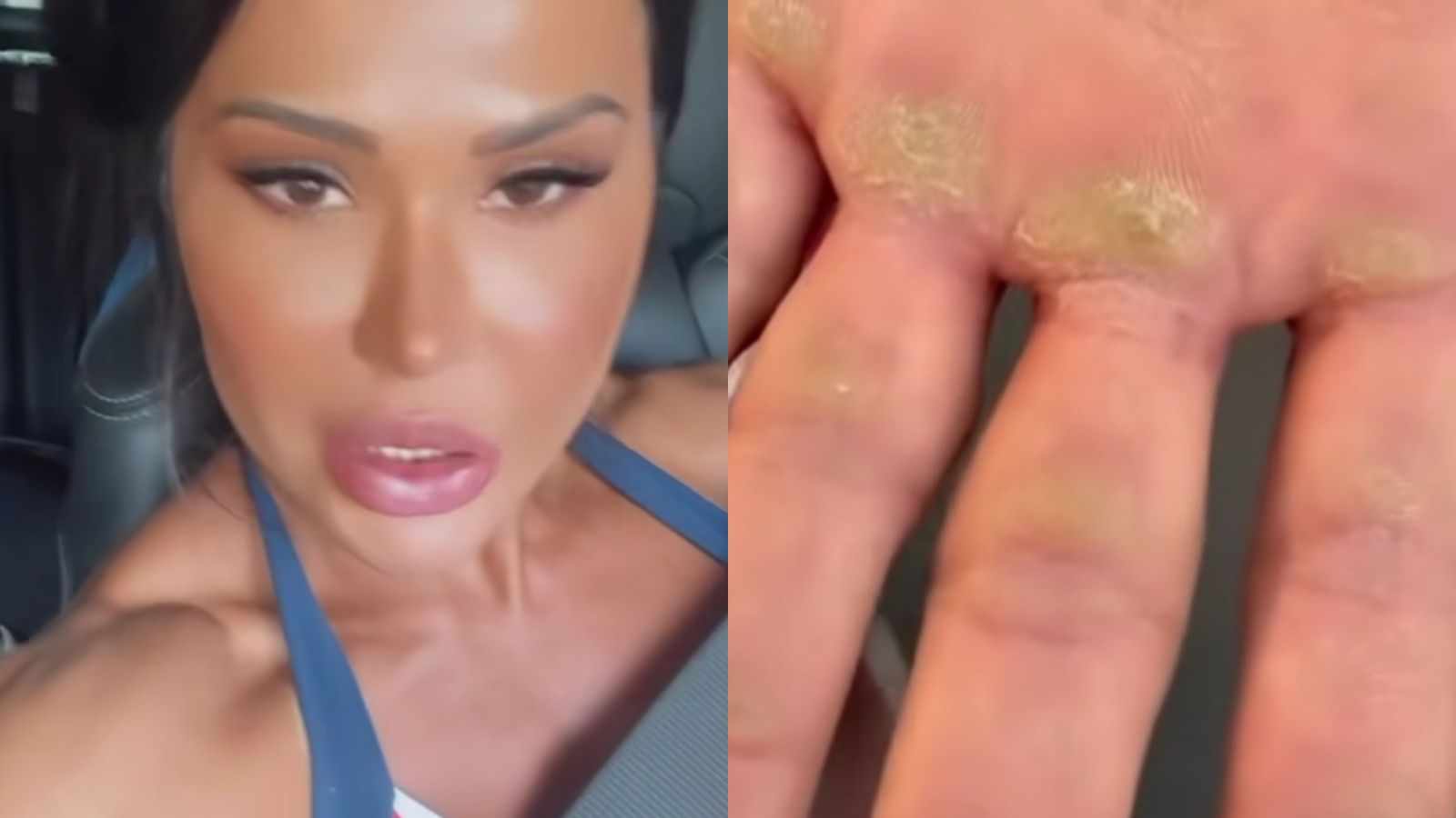 Efeito colateral! Gracyanne Barbosa mostra dano do treino em seu corpo