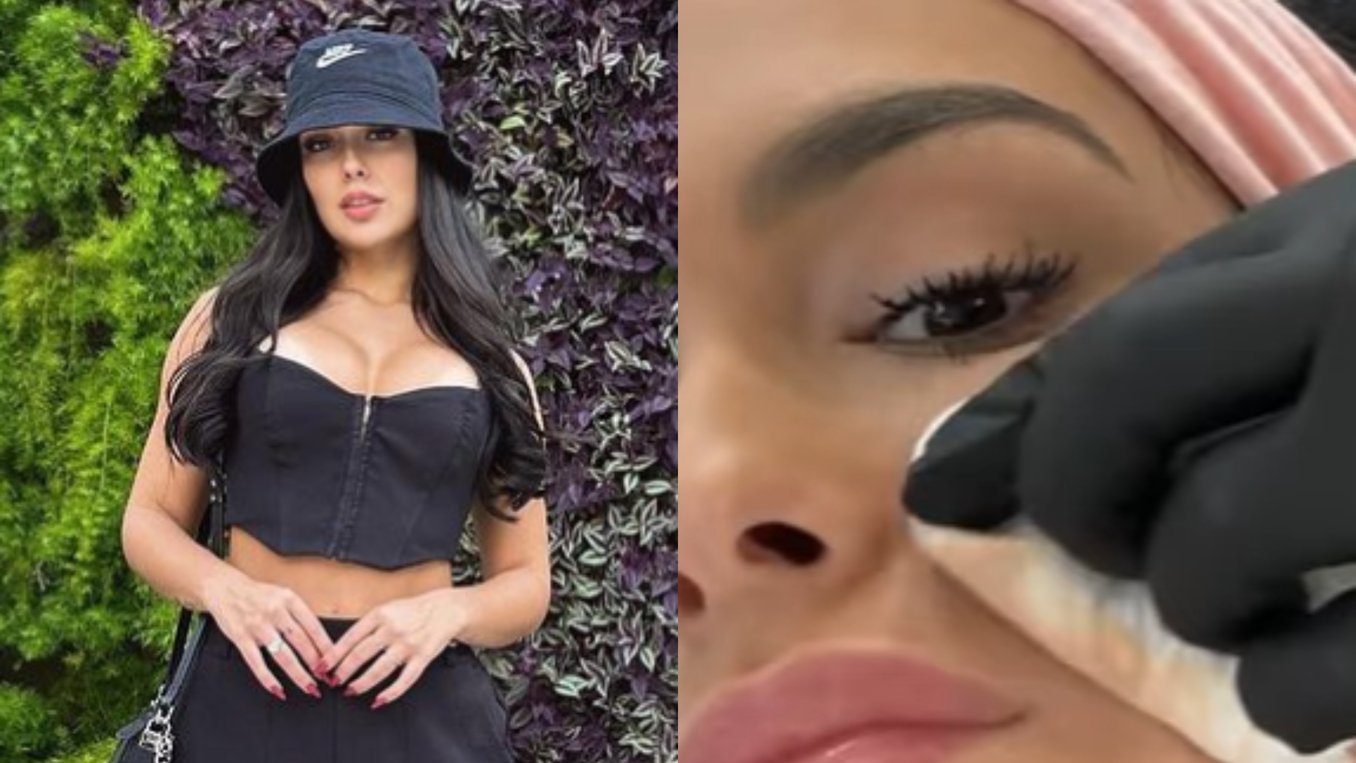 Larissa Santos recorre a harmonização facial; veja o antes e depois