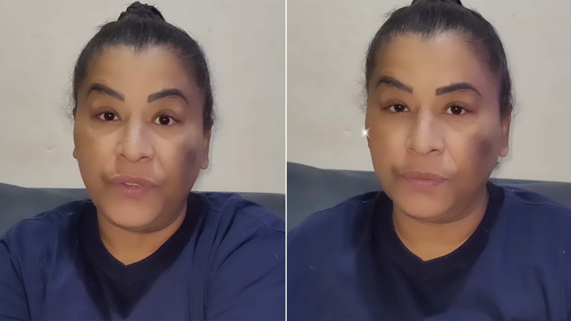 MC Katia tem parte do corpo amputada após problema de saúde. Entenda o que aconteceu