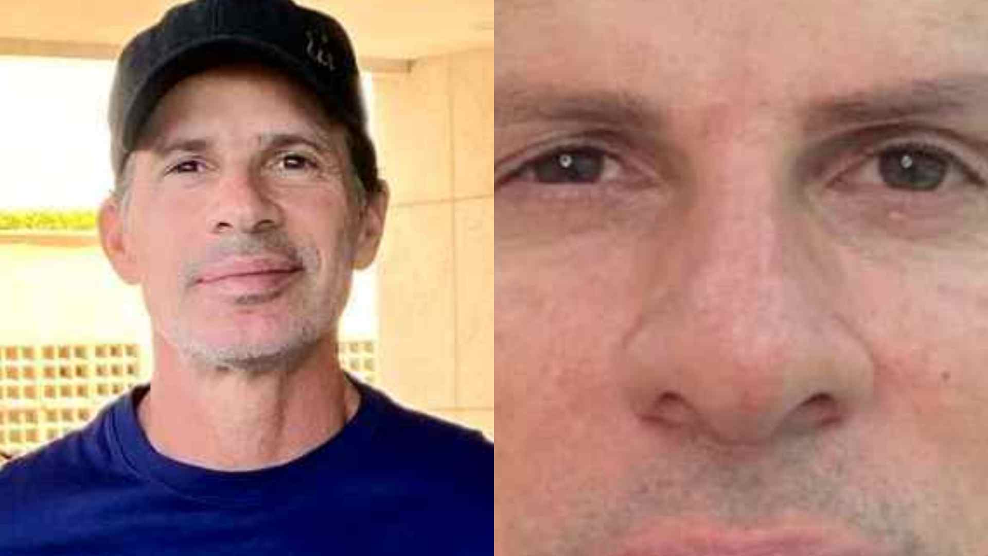 Ex-jogador Túlio Maravilha impressiona ao mostrar resultado de harmonização facial