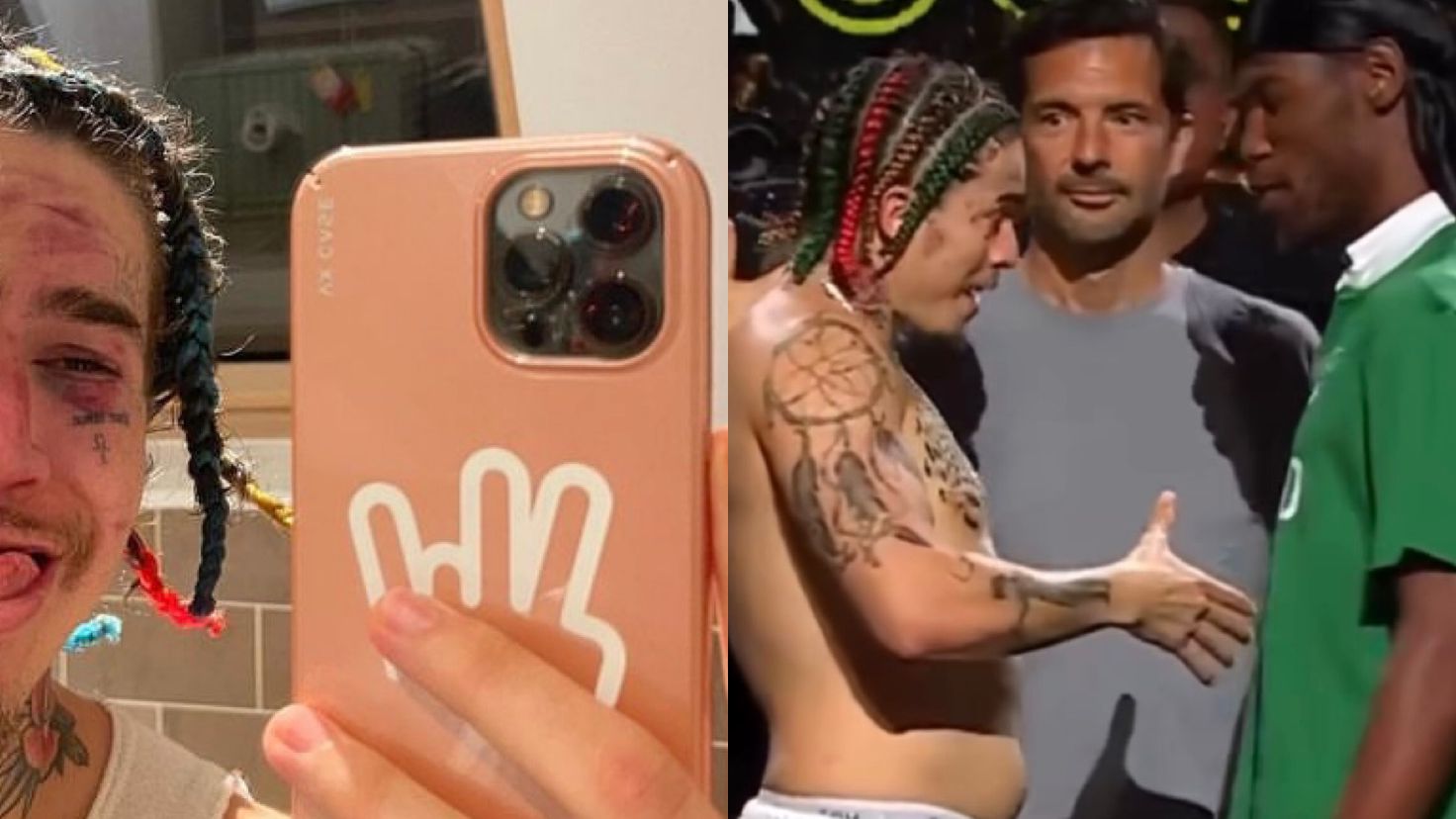 Whindersson Nunes perde luta de boxe e mostra rosto machucado; veja