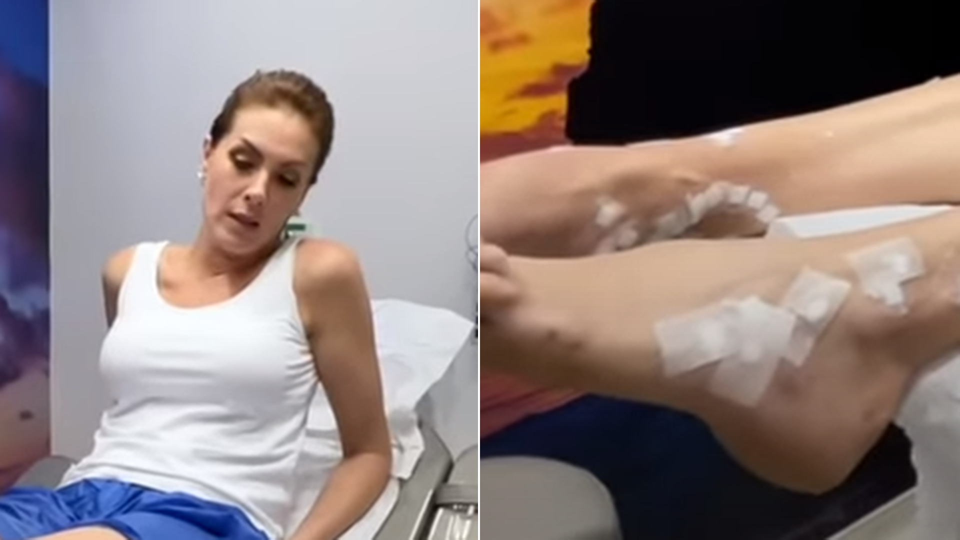 Ana Hickmann revela tratamento nas pernas: ‘Sofro com isso há muito tempo’