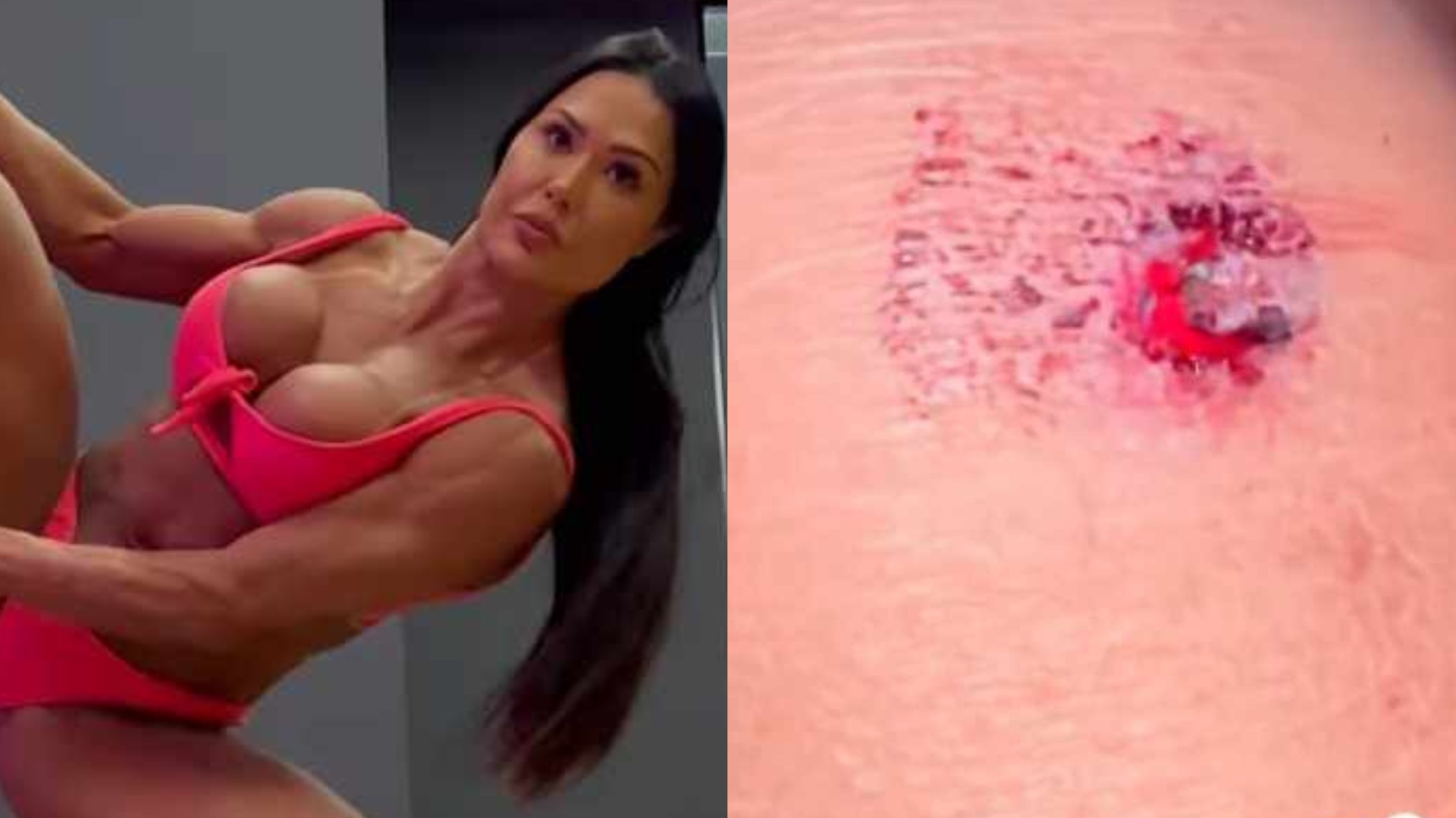 Gracyanne Barbosa sofre acidente e mostra machucado: ‘Pele arrancou’