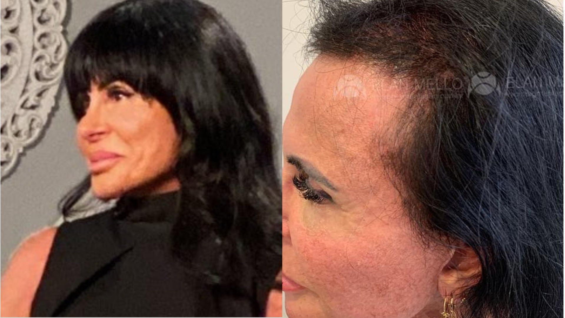 Gretchen revela procedimento para cobrir ‘careca’ da cabeça: ‘Nunca tinha visto’