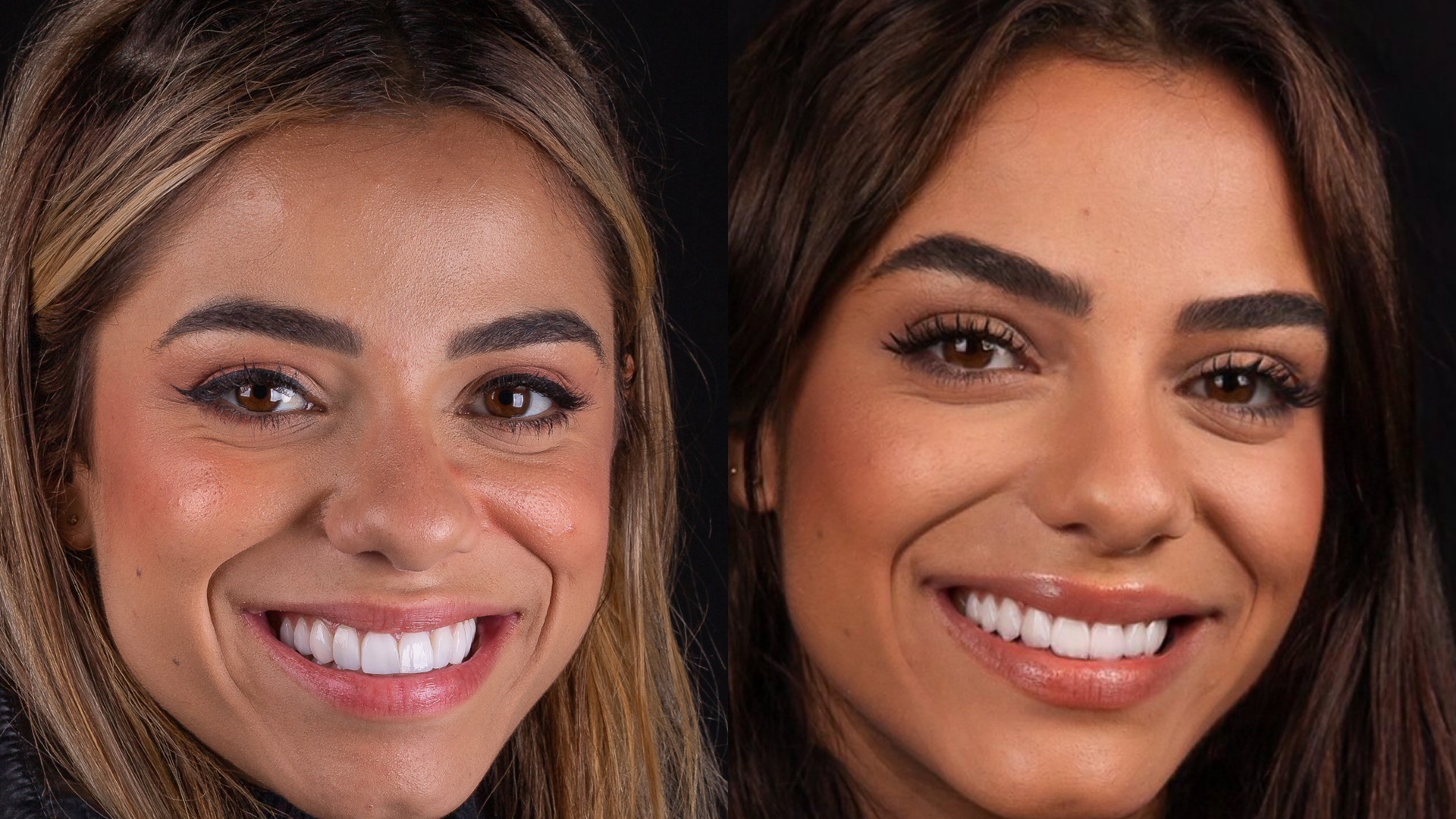 Quanto custou o novo sorriso de Key Alves? Especialista avalia mudança estética