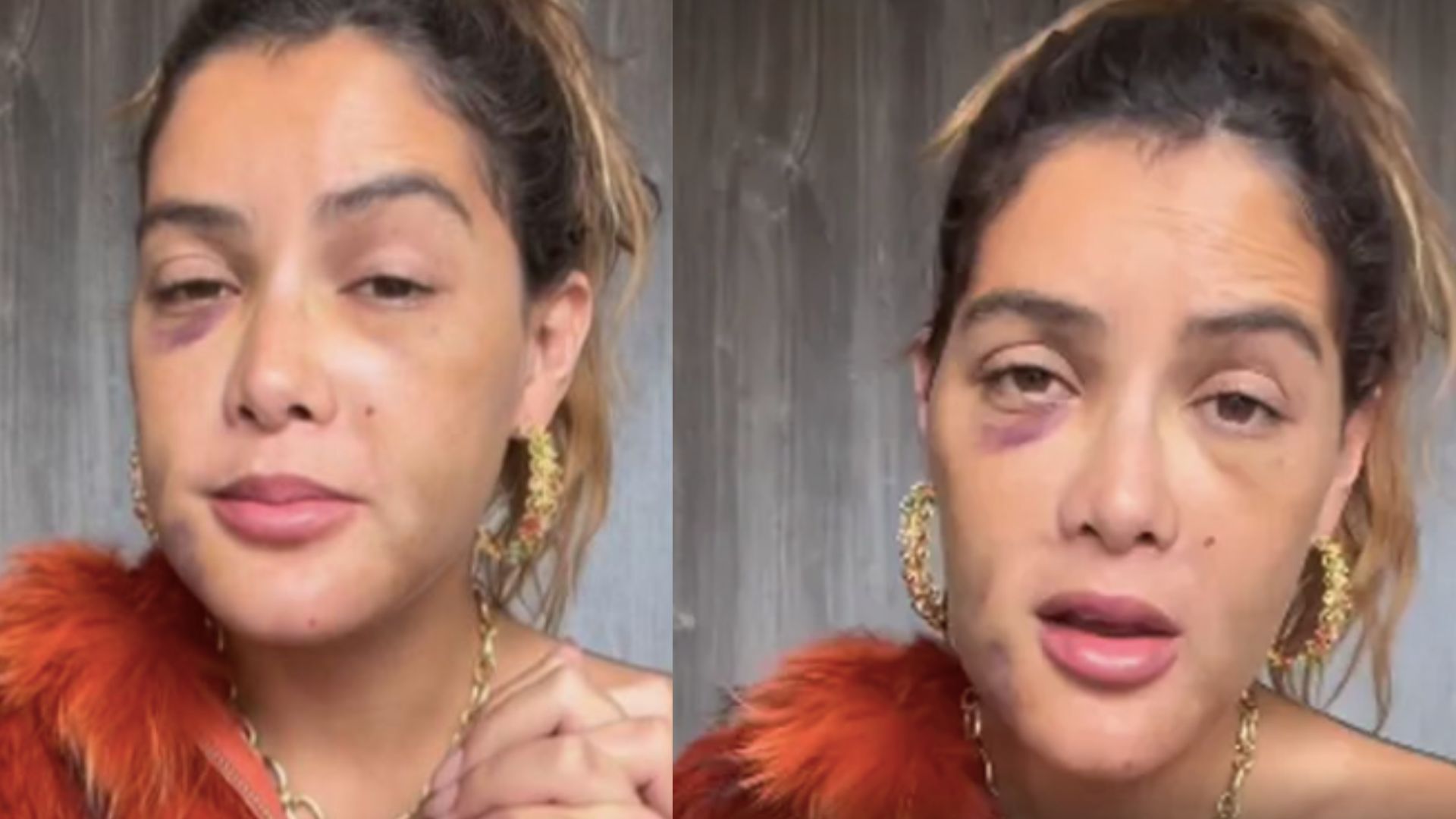 Atriz da novela ‘Quanto Mais Vida, Melhor’ passa por cirurgia: ‘Bomba-relógio em meu rosto’