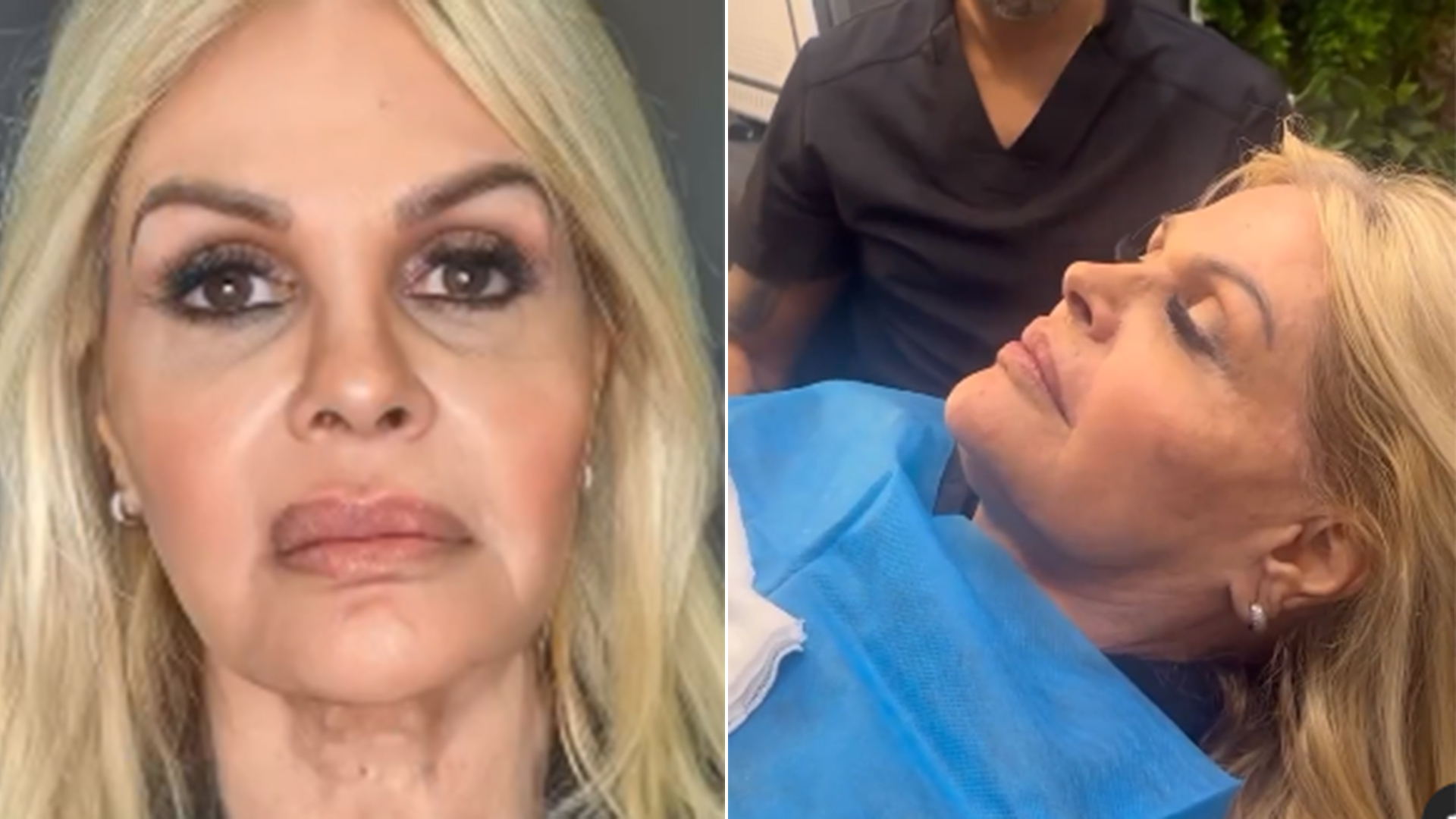 Monique Evans impressiona com antes e depois de harmonização facial