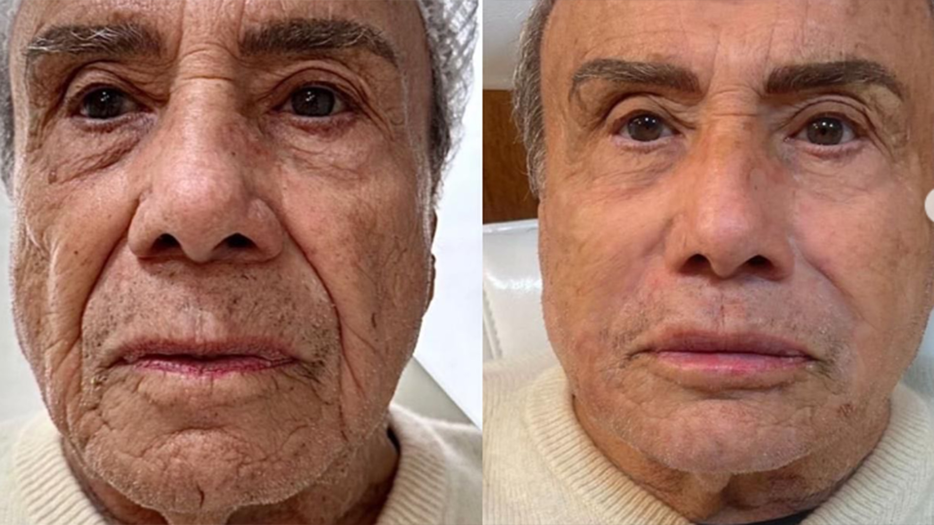 Stenio Garcia revela verdadeiro motivo para ter feito a harmonização facial