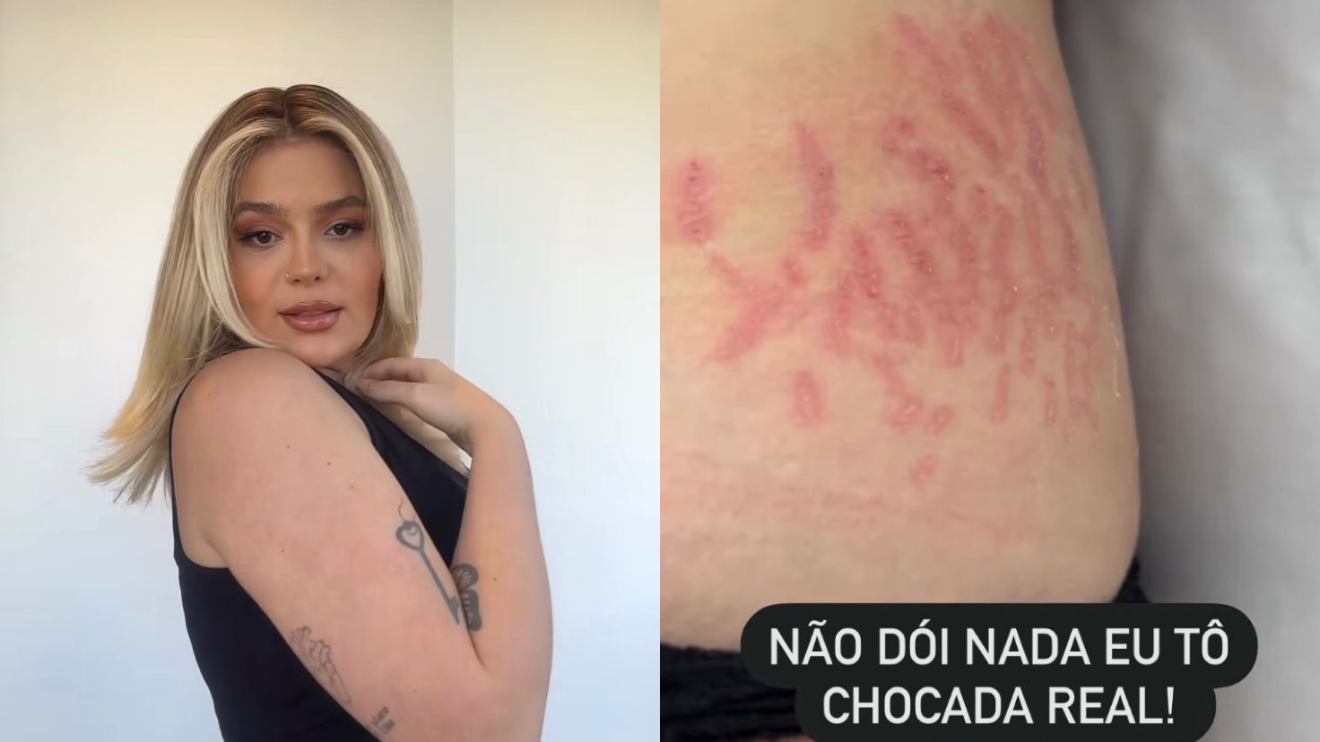 Viih Tube faz tratamento para estrias da gravidez: ‘Não dói’