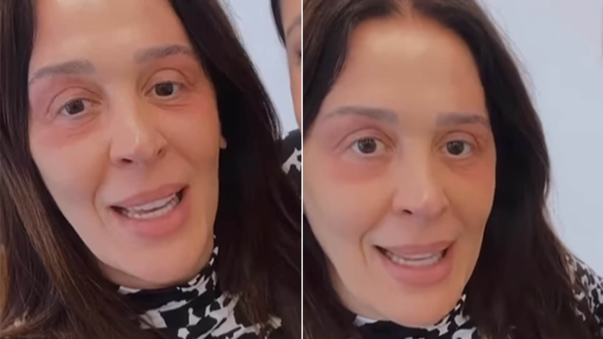 Claudia Raia surge com o olho vermelho e explica o que fez