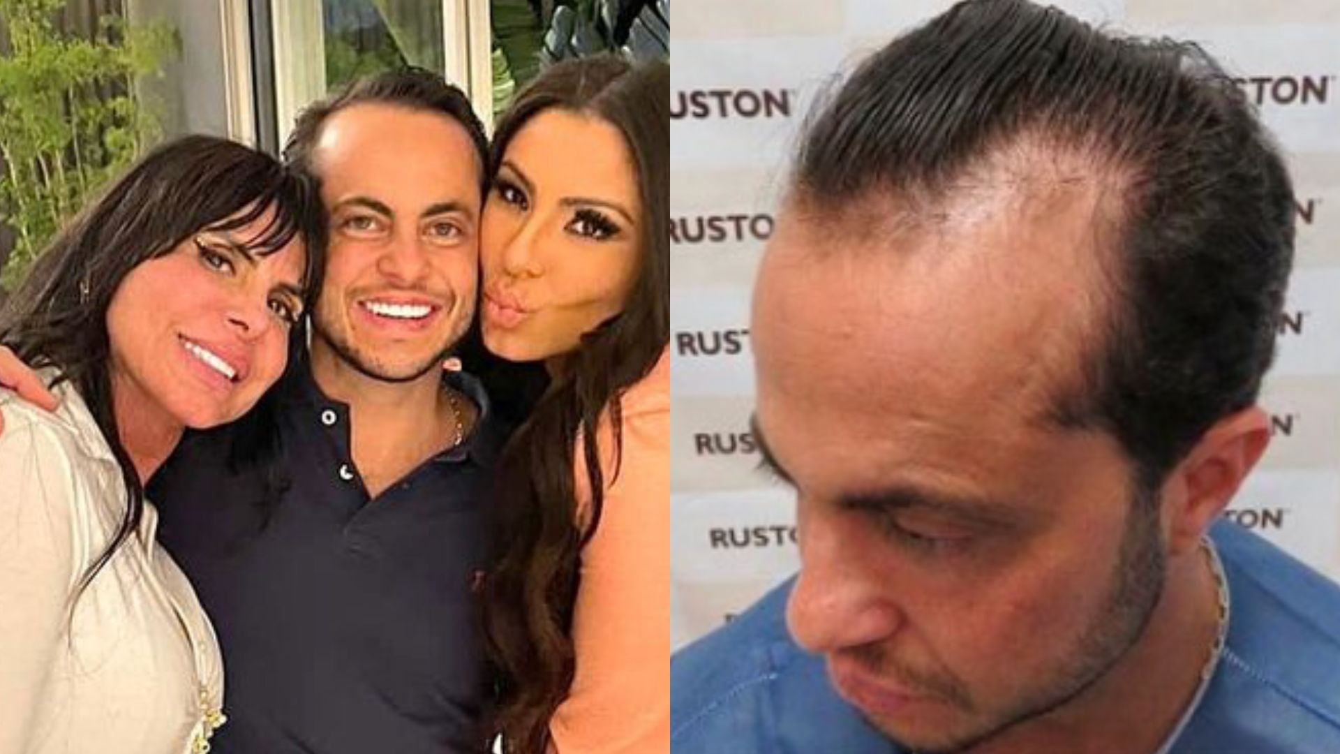 Thammy Miranda mostra antes e depois de transplante capilar: “Impressionante!”