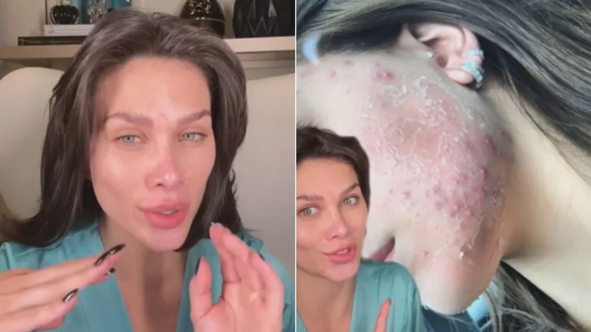 Flávia Pavanelli expõe problemas com acne: “Passava pelo espelho de costas”