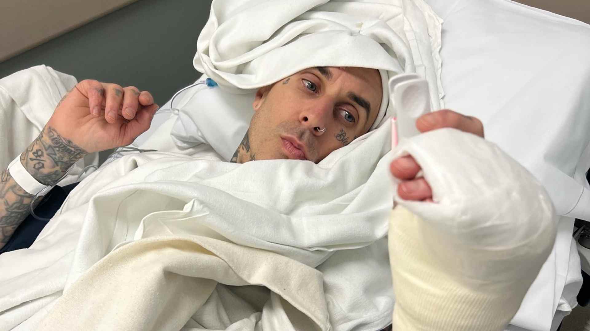 Após cirurgia, Travis Barker impressiona ao mostrar foto do dedo e agradece mensagens de apoio