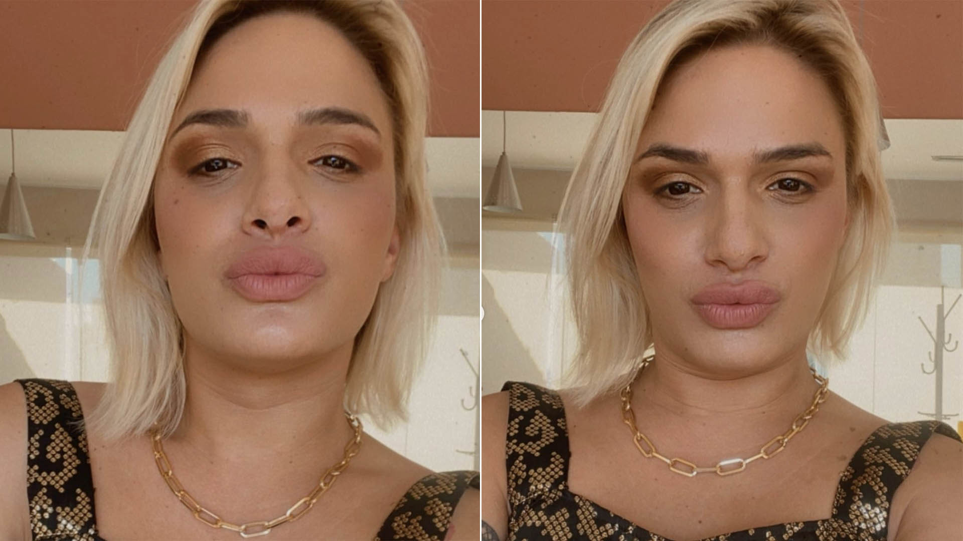 Glamour Garcia passa por cirurgia de redesignação sexual em Blumenau