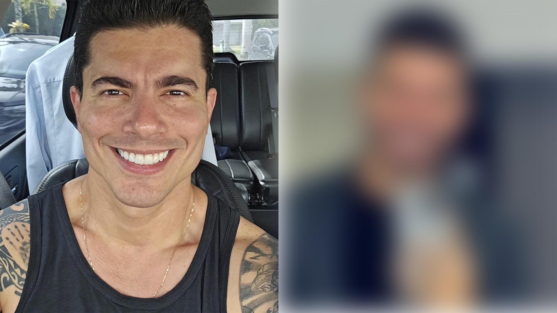 Apresentador da Globo, Wagner Montes Filho faz transplante de barba