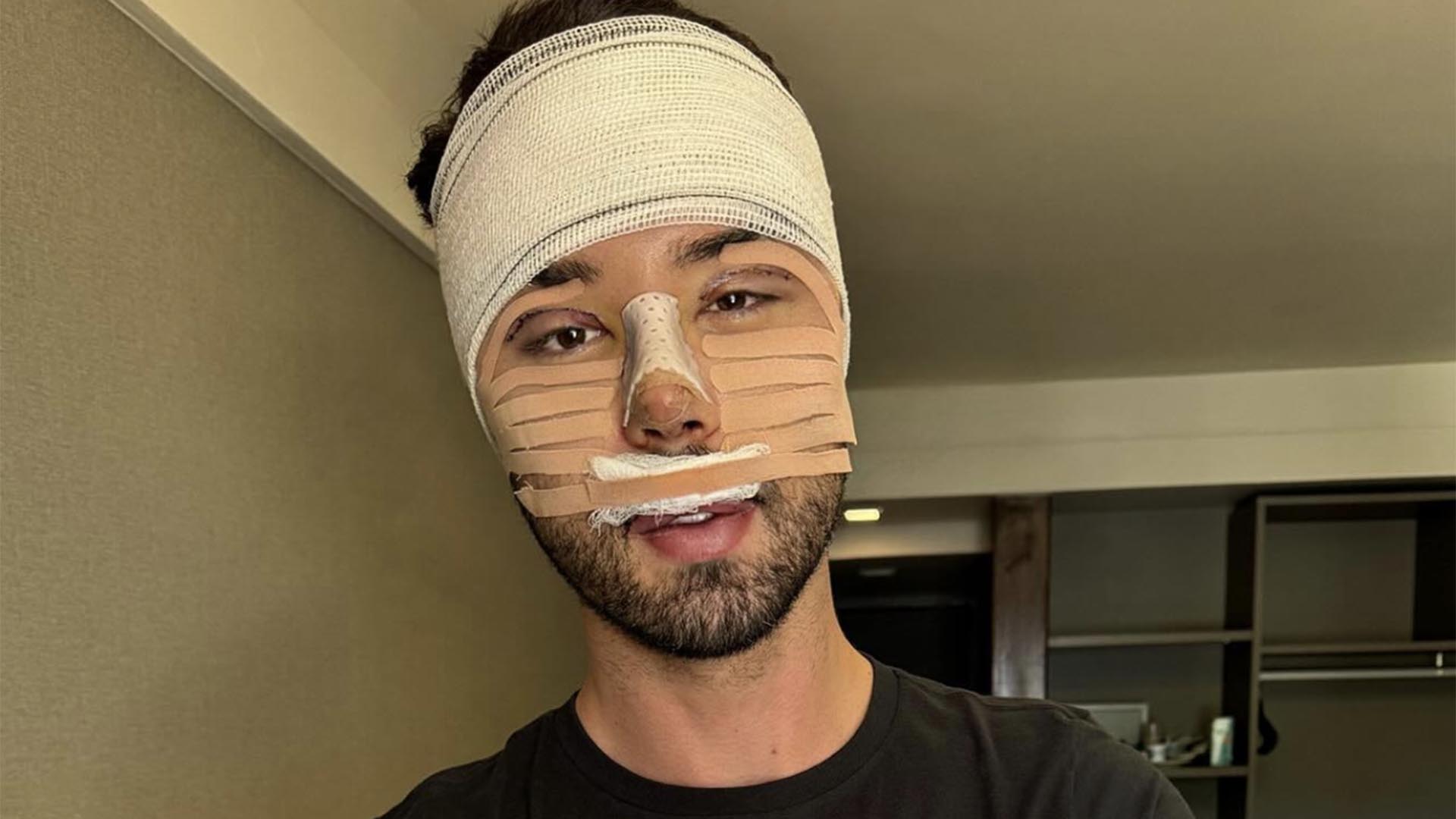 Rico Melquiades revela o resultado da cirurgia plástica no rosto