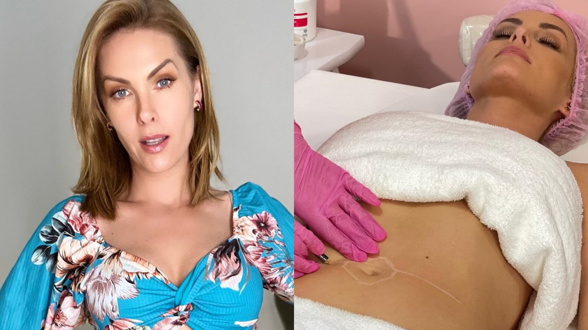 Ana Hickmann impressiona ao mostrar procedimento estético para retirar gordura localizada