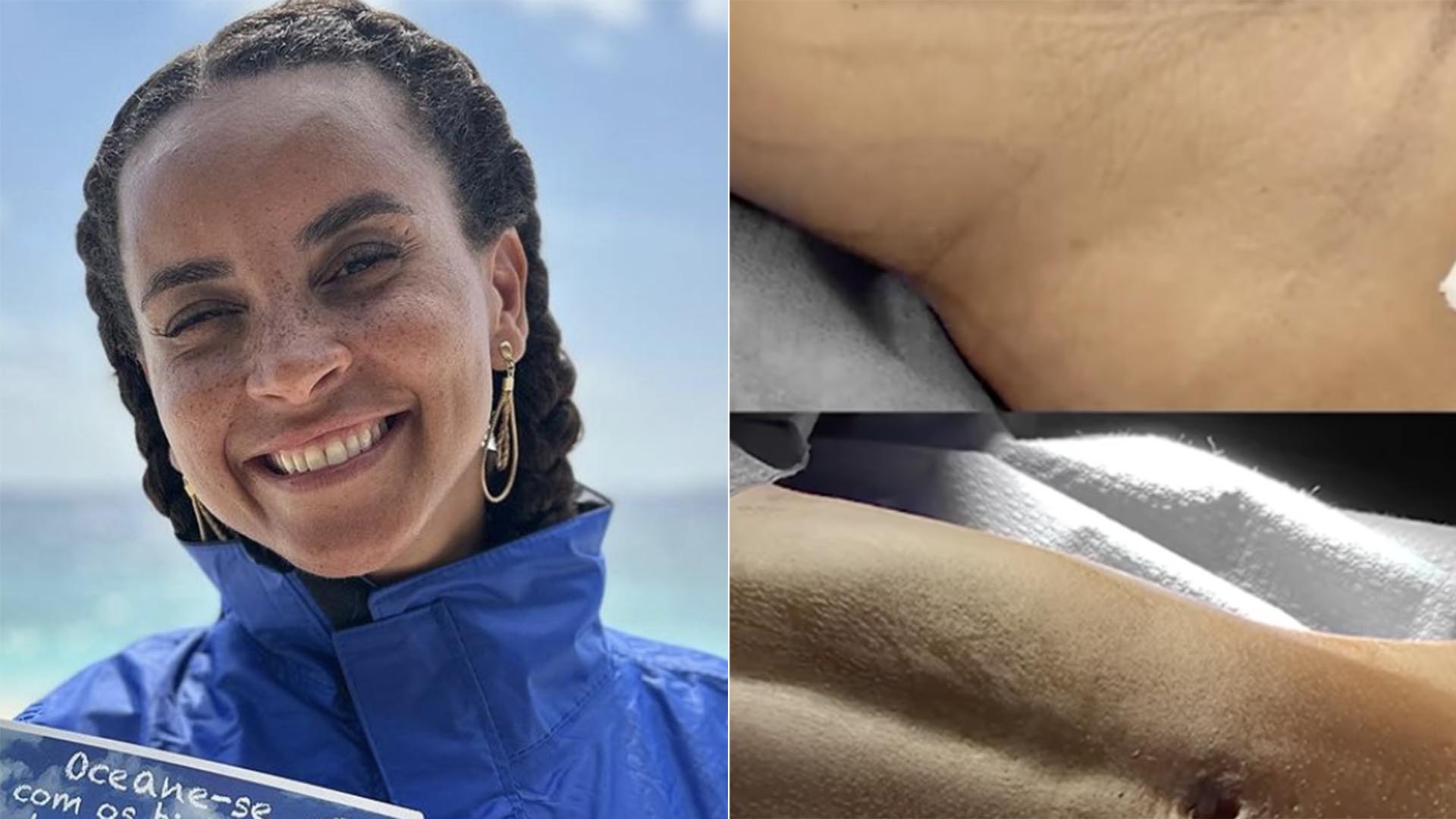 Ex-BBB Domitila faz sua primeira cirurgia plástica e choca com o resultado