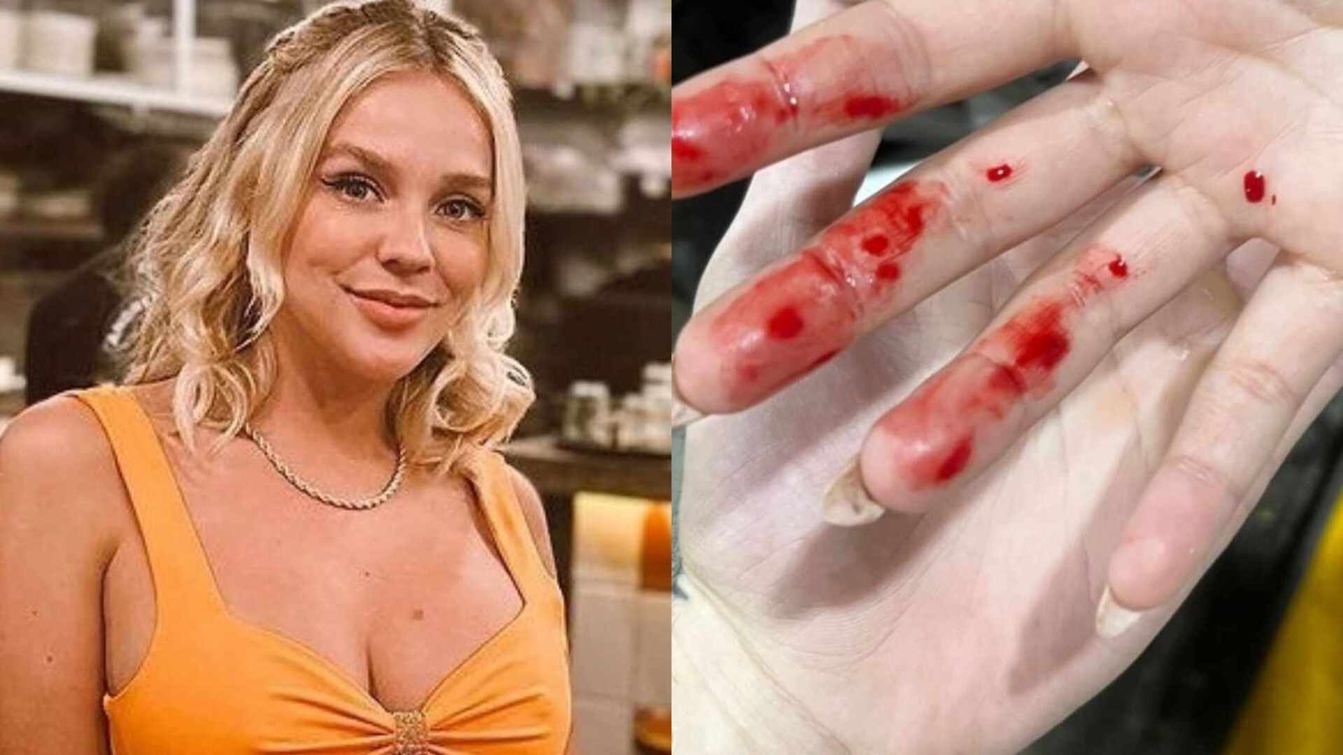 Gabi Lopes choca ao mostrar ferimentos após assalto: ”Filme de terror”