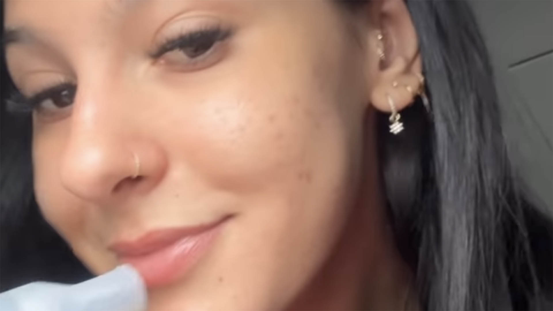 Ana Castela mostra antes e depois do seu rosto ao iniciar tratamento