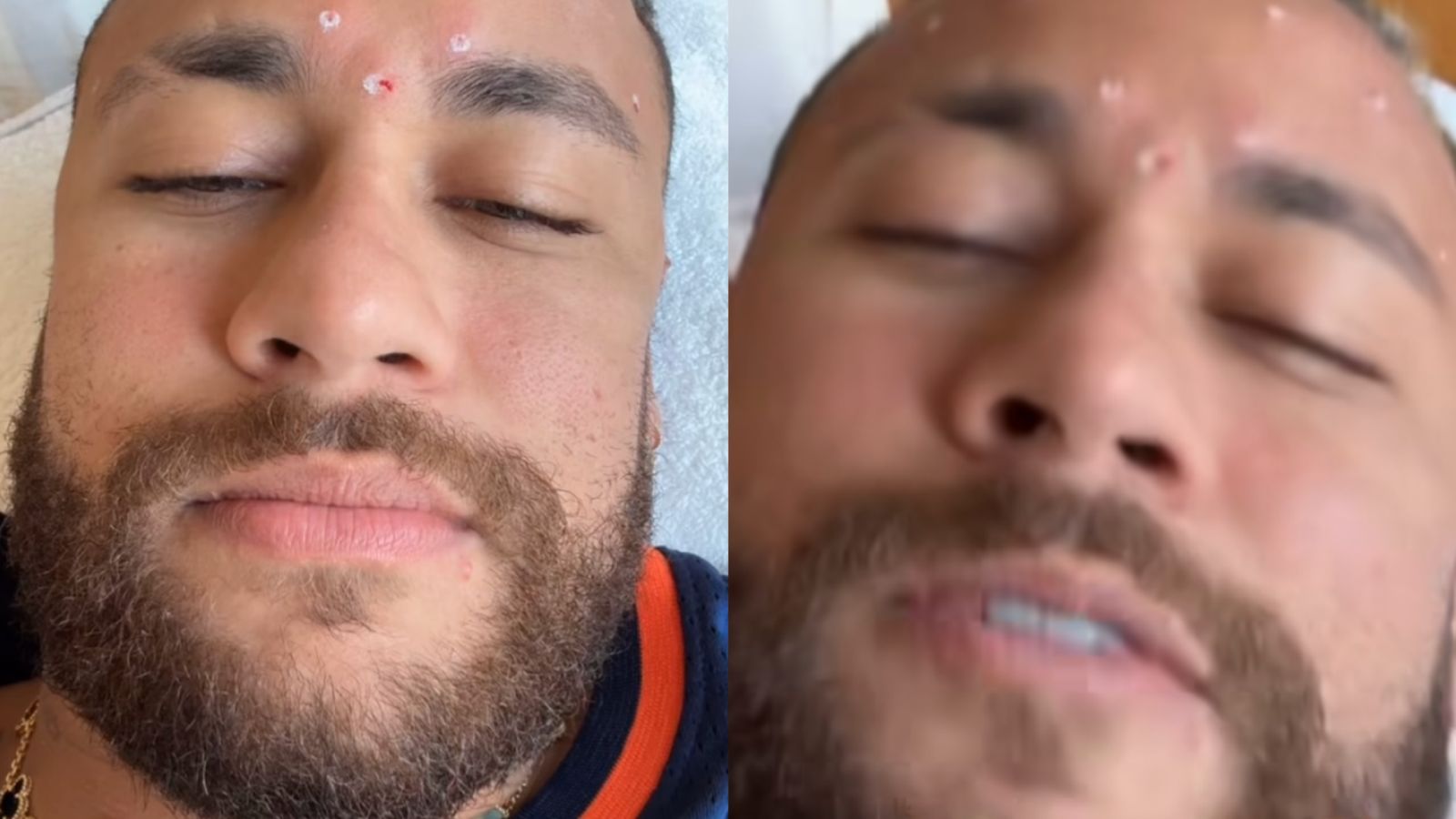 O que Neymar Jr fez no rosto? Jogador retocou seus procedimentos estéticos