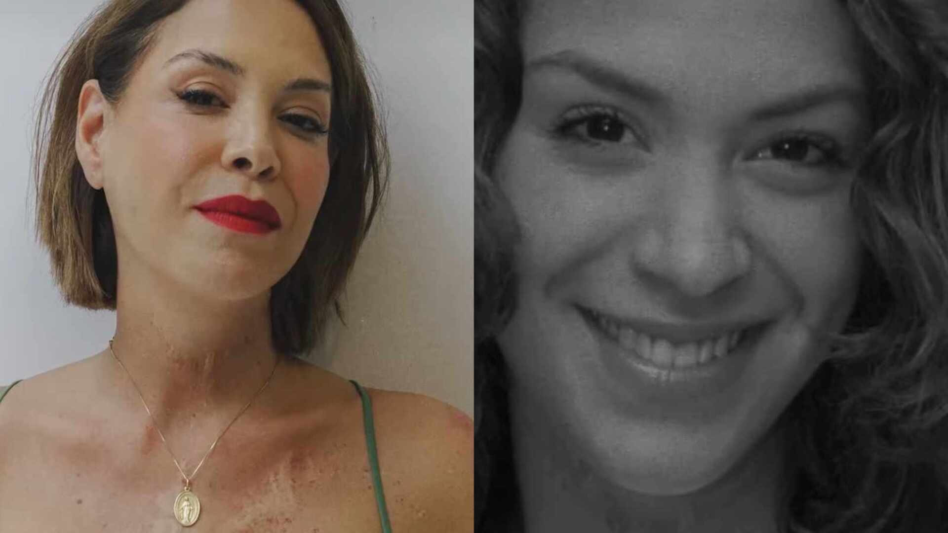 Júlia Almeida exibe suas cicatrizes e faz reflexão: ‘Uma história’